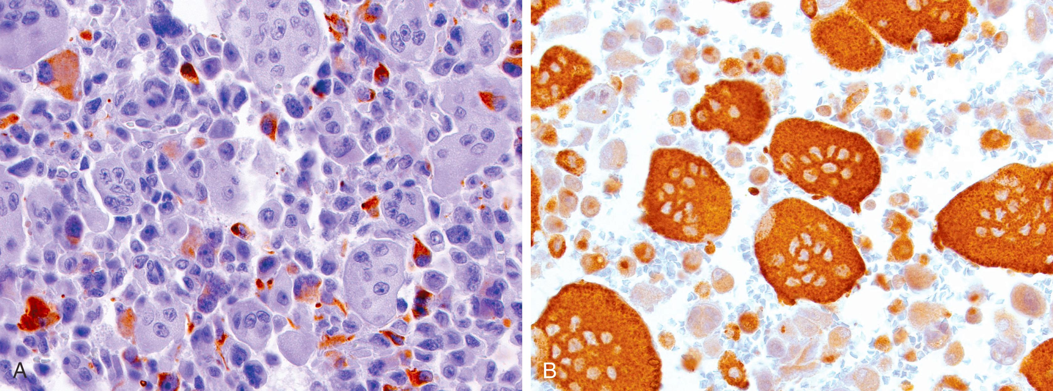 Fig. 15.8, In undifferentiated carcinoma with osteoclast-like giant cells of the pancreas, the osteoclast-like giant cells are negative for AE1/AE3 (A) and are positive for CD68 (B).