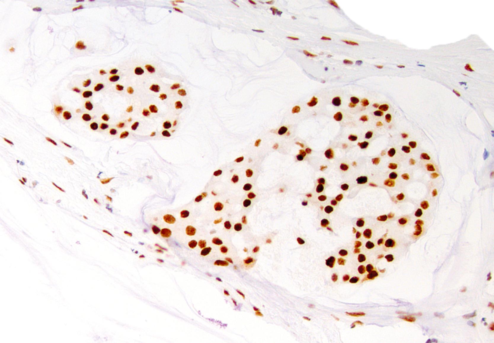 Fig. 15.10, Colloid carcinomas also express CDX2, diffusely.