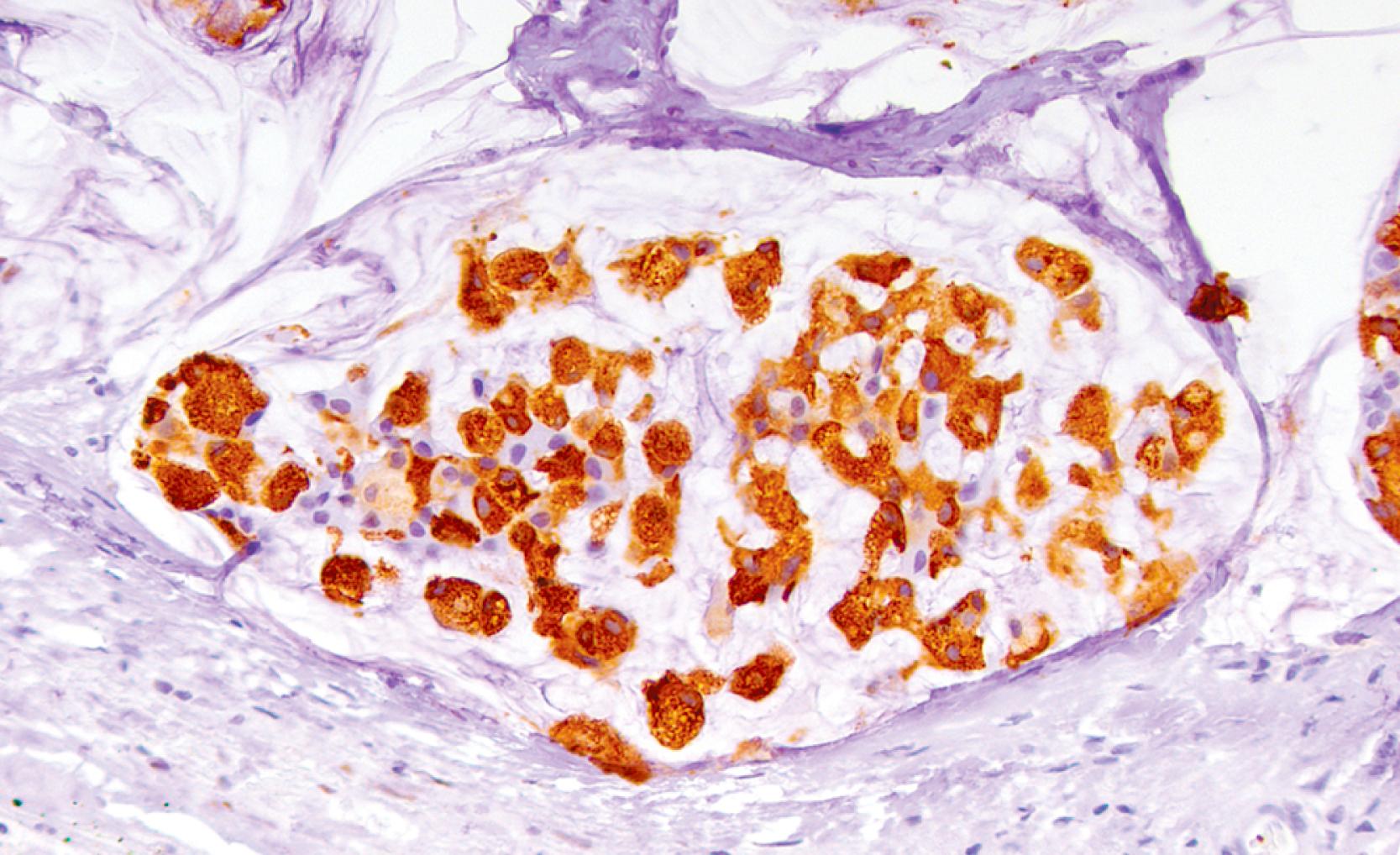 Fig. 15.9, Strong and often diffuse intracytoplasmic MUC2 labeling is specific for colloid carcinoma.