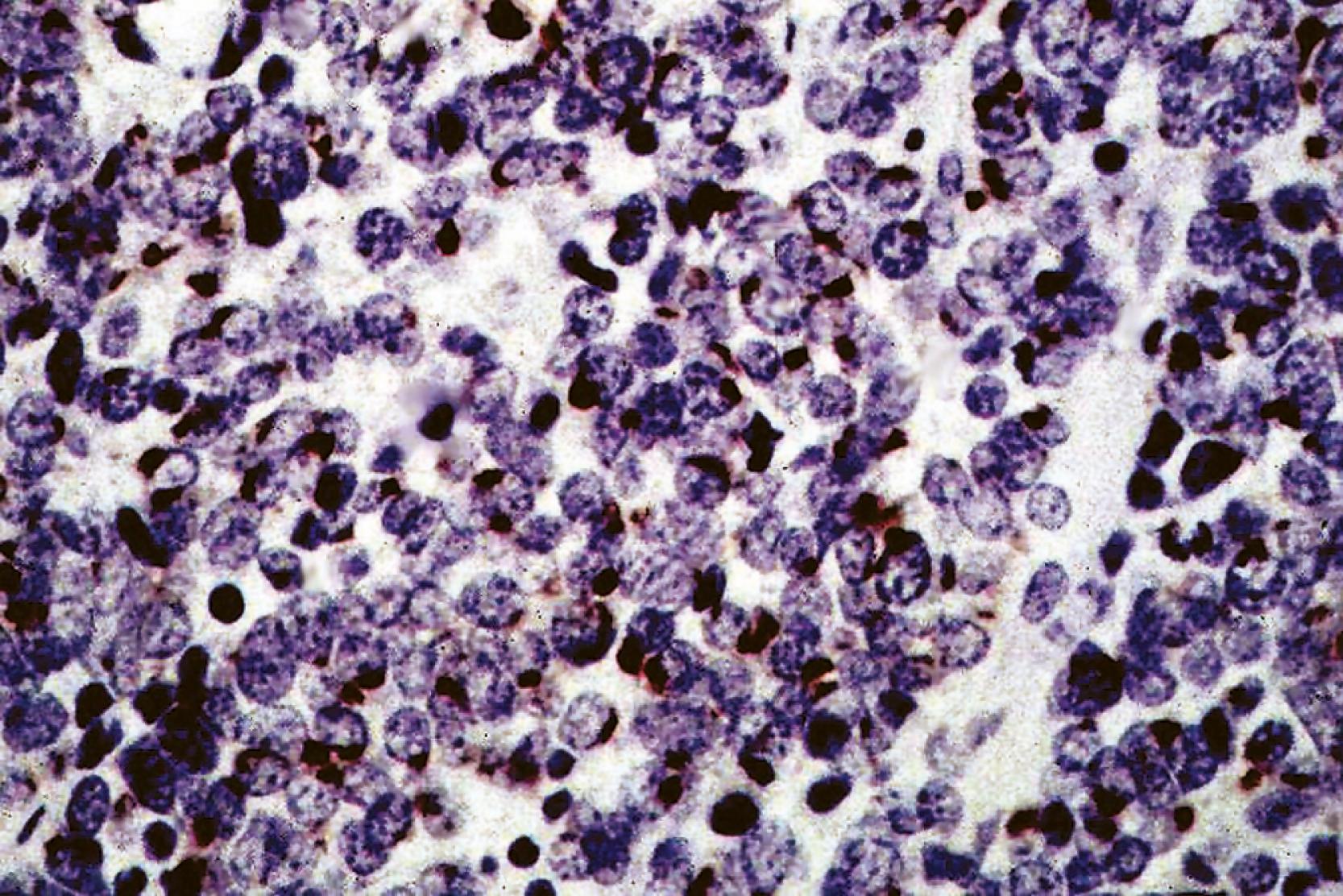 Fig. 13.13, Perinuclear keratin dot-like reactivity in Merkel cell carcinoma. That pattern simultaneously identifies the tumor as epithelial and neuroendocrine, and it is only very rarely seen in neuroendocrine tumors outside the skin, mainly in the salivary gland (antikeratin; diaminobenzidine and light hematoxylin).