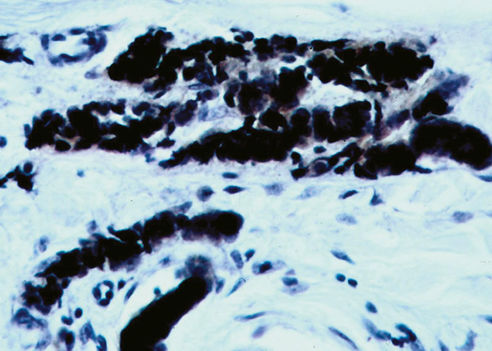 Fig. 13.14, Diffuse nuclear positivity for thyroid transcription factor 1 in metastatic small cell neuroendocrine carcinoma arising in the lung and involving the skin. That marker is exceptionally seen in Merkel cell carcinoma (diaminobenzidine and light hematoxylin).