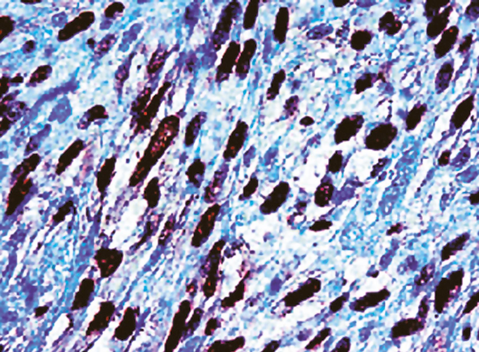 Fig. 13.2, Positivity for p63 protein in poorly differentiated squamous cell carcinoma of the skin (anti-p63; diaminobenzidine and light hematoxylin).