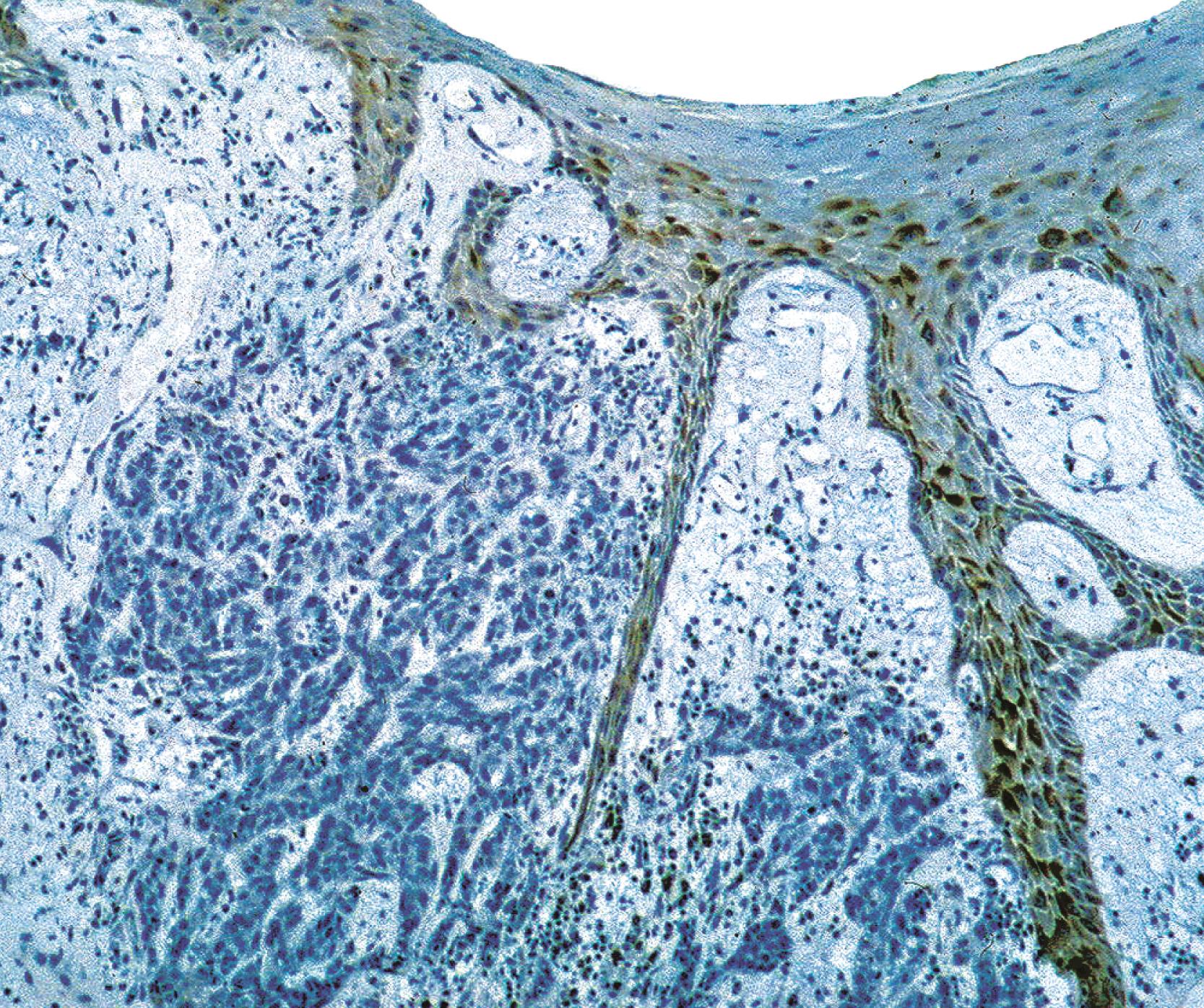 Fig. 13.3, Negative epithelial membrane antigen (EMA) in basal cell carcinoma. Note the positivity in the overlying epidermis (anti-EMA; diaminobenzidine and light hematoxylin).