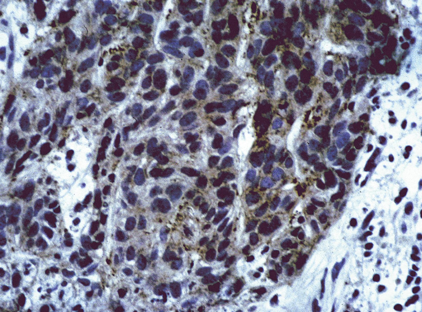 Fig. 13.4, Diffuse immunoreactivity for BerEP4 in basal cell carcinoma (anti-BerEP4; diaminobenzidine and light hematoxylin).