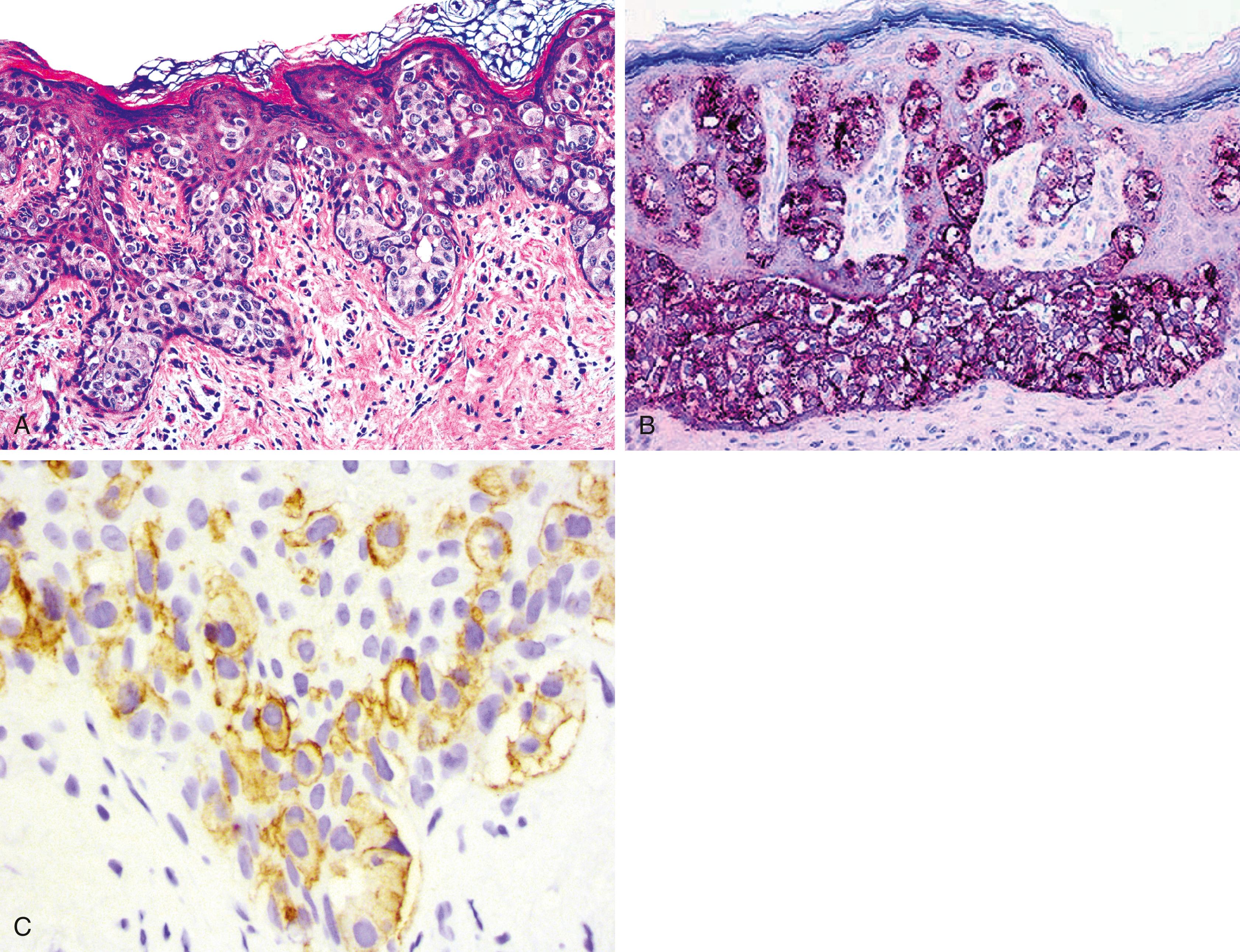 Fig. 13.6, (A) Extramammary Paget disease of the skin. (B) Reactivity for gross cystic disease fluid protein-15 (GCDFP-15) is often demonstrated. (C) Some cases express ERBB2 (formerly Her2/neu) and thus may be amenable to treatment with Herceptin (anti-ERBB2; diaminobenzidine and light hematoxylin).