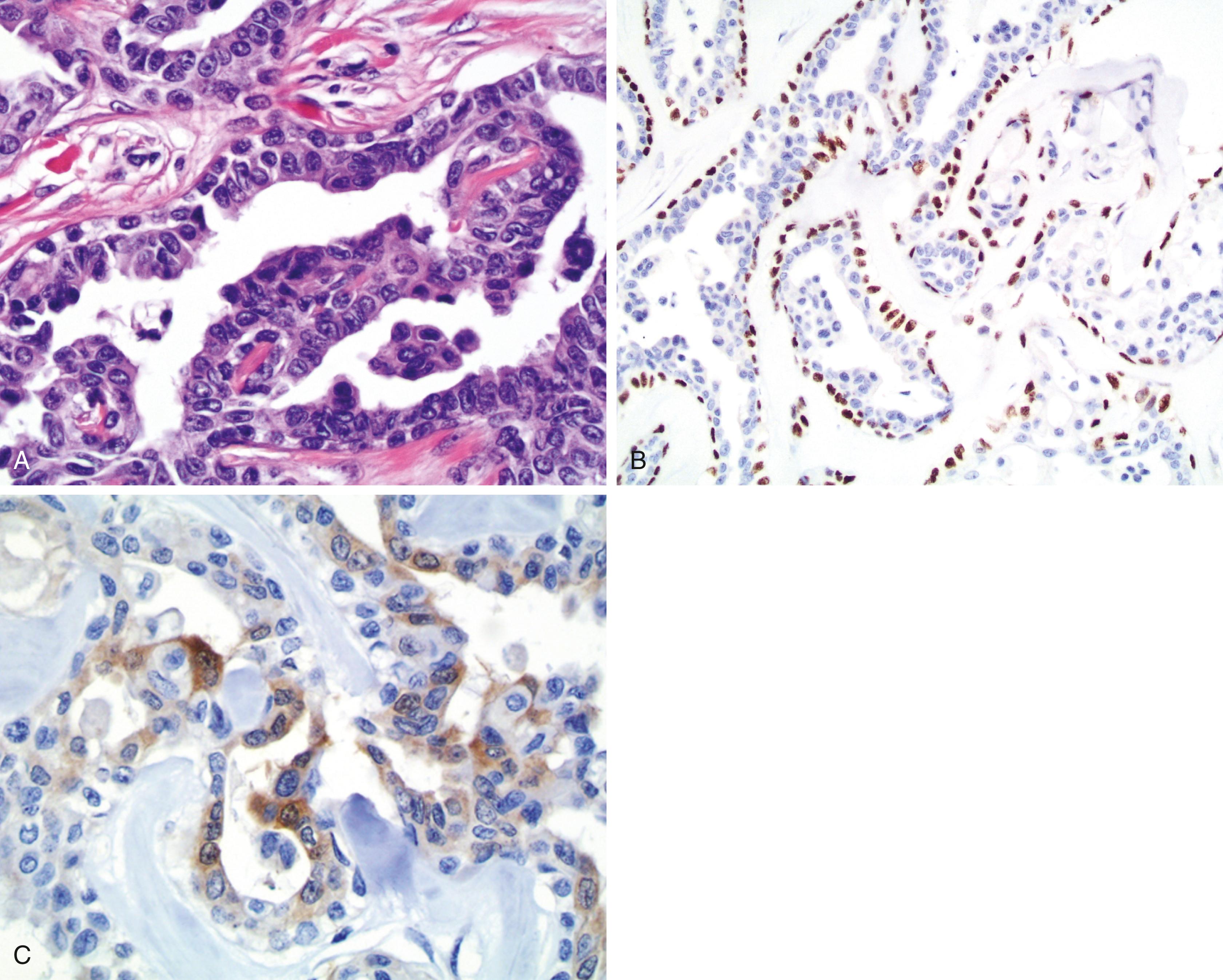 Fig. 13.7, (A) Primary eccrine carcinoma in the skin with papillary features. (B) Positivity for p63 is shown in more than 25% of the tumor cells. (C) Focal calretinin expression is also apparent (anti-p63 and anti-calretinin; diaminobenzidine and light hematoxylin).