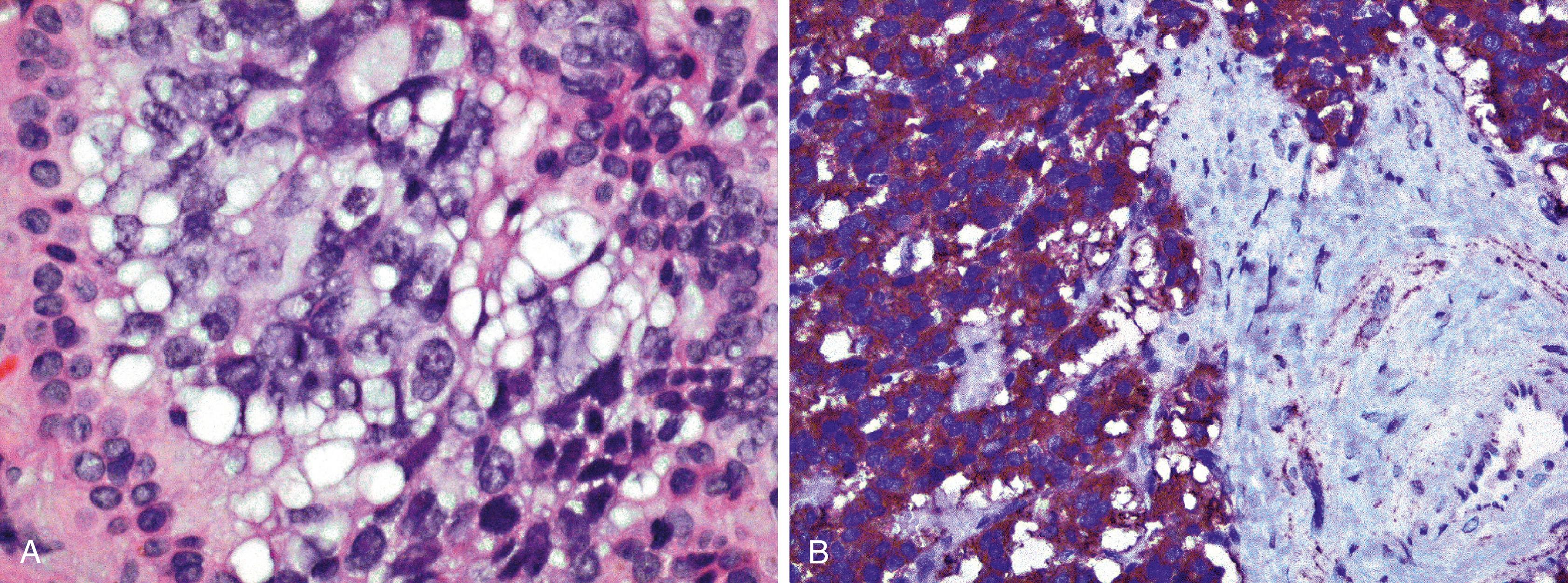 Fig. 13.8, Sebaceous carcinoma (A) usually demonstrates diffuse reactivity for epithelial membrane antigen (B), often with a “bubbly” cytoplasmic pattern of staining.