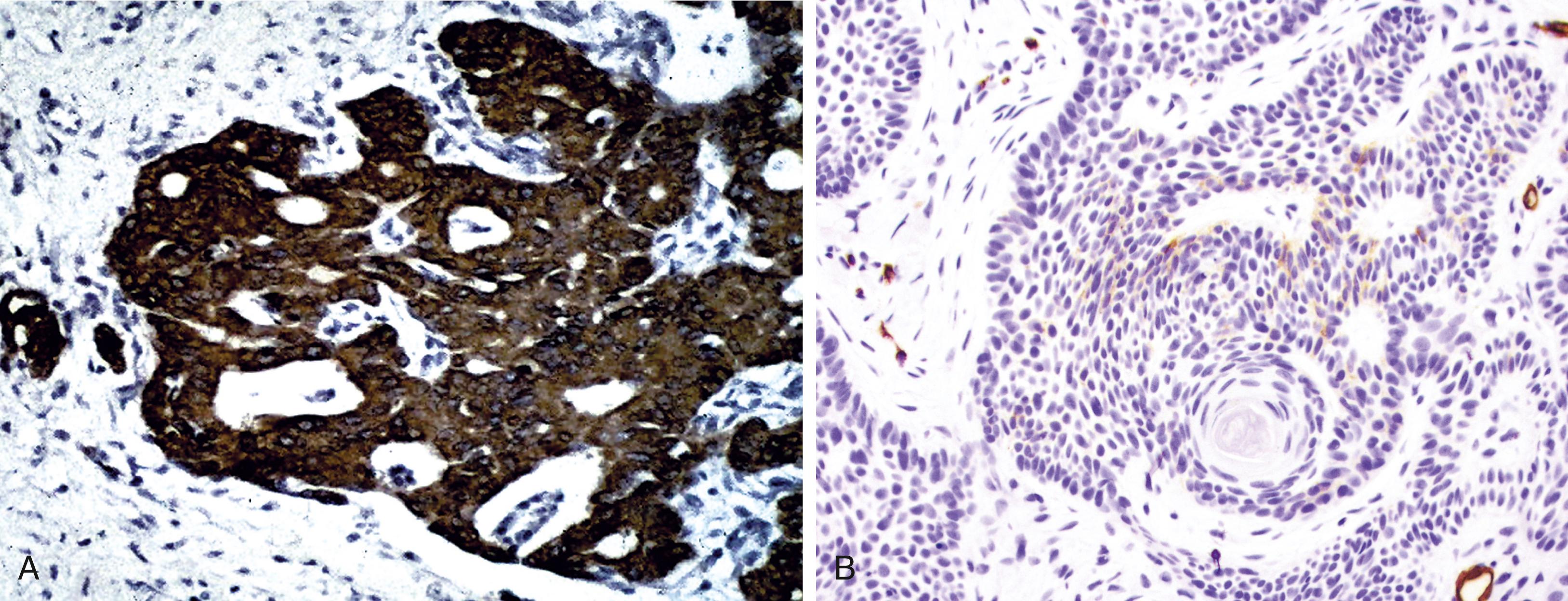 Fig. 13.9, (A) Positivity for Bcl-2 protein in basal cell carcinoma. (B) In contrast with trichoepithelioma, no significant labeling of peritumoral spindle cells is seen (anti-CD34 and anti–Bcl-2; diaminobenzidine and light hematoxylin).