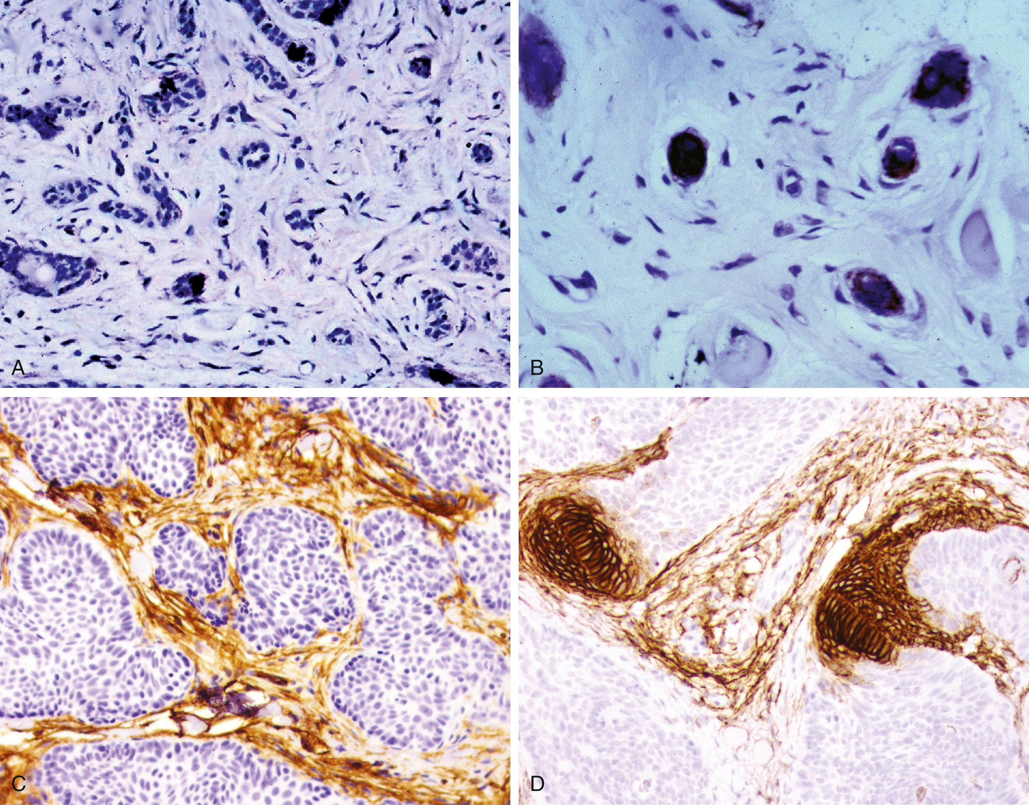 Fig. 13.10, (A) Reactivity for chromogranin A is apparent in scattered cell nests in desmoplastic trichoepithelioma. (B) Similar reactivity is apparent with CK20. (C and D) Note the extensive labeling for CD34 and CD10 in the stromal cells that surround the clusters of trichoepithelioma tumor cells. Those antigens are typically absent in sclerosing basal cell carcinoma, which is the principal differential diagnostic consideration.