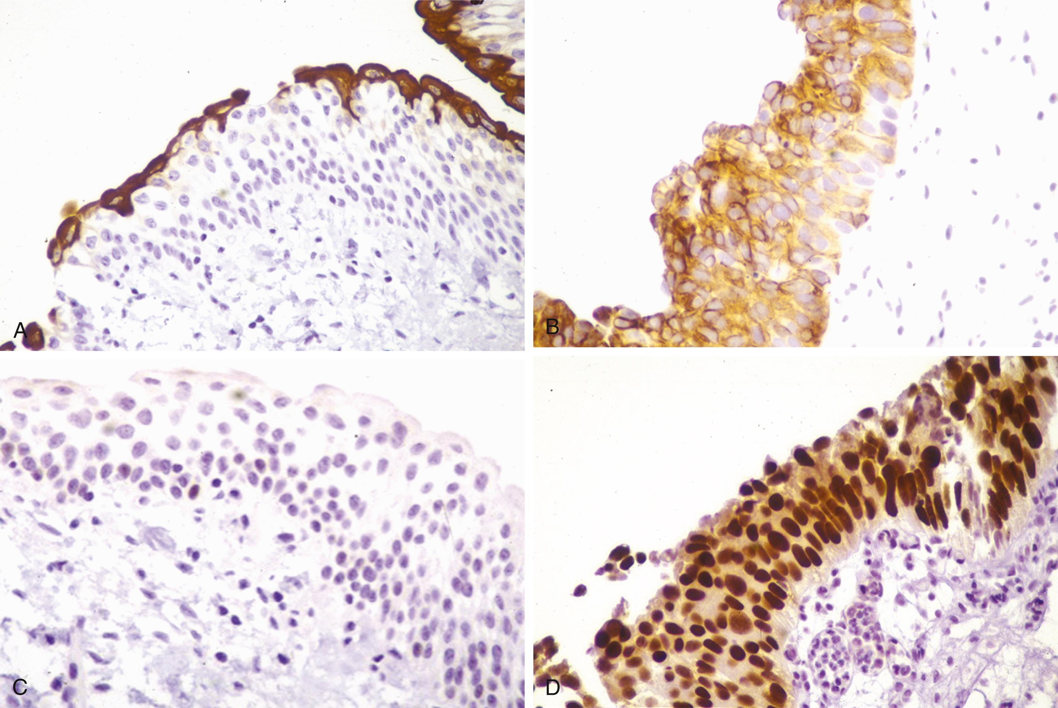 Fig. 17.1, Cytokeratin 20 (CK20) and p53 staining as an adjunct to differentiate reactive urothelial atypia (A and C) from urothelial carcinoma in situ (B and D). (A and B) CK20 immunostain. (C and D) p53 immunostain.