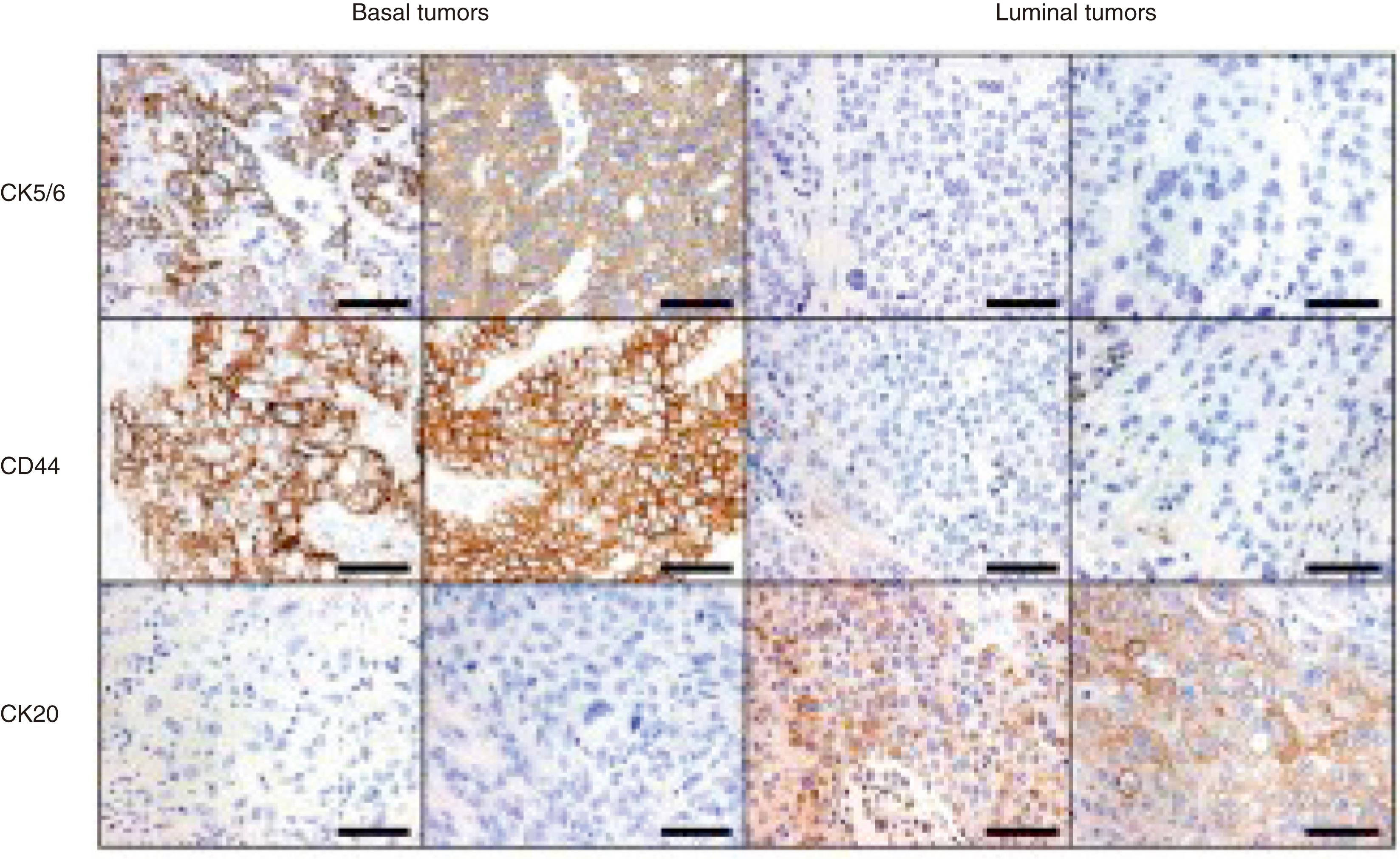 Fig. 17.12, Immunohistochemical analysis of basal and luminal markers expression in bladder cancer. The basal and luminal immunoprofiles (CK5/6+, CD44+, CK20− and CK5/6−, CD44−, CK20+, respectively) are shown in basal (left) and luminal (right) tumors that were categorized as such based on gene expression profiling is shown.