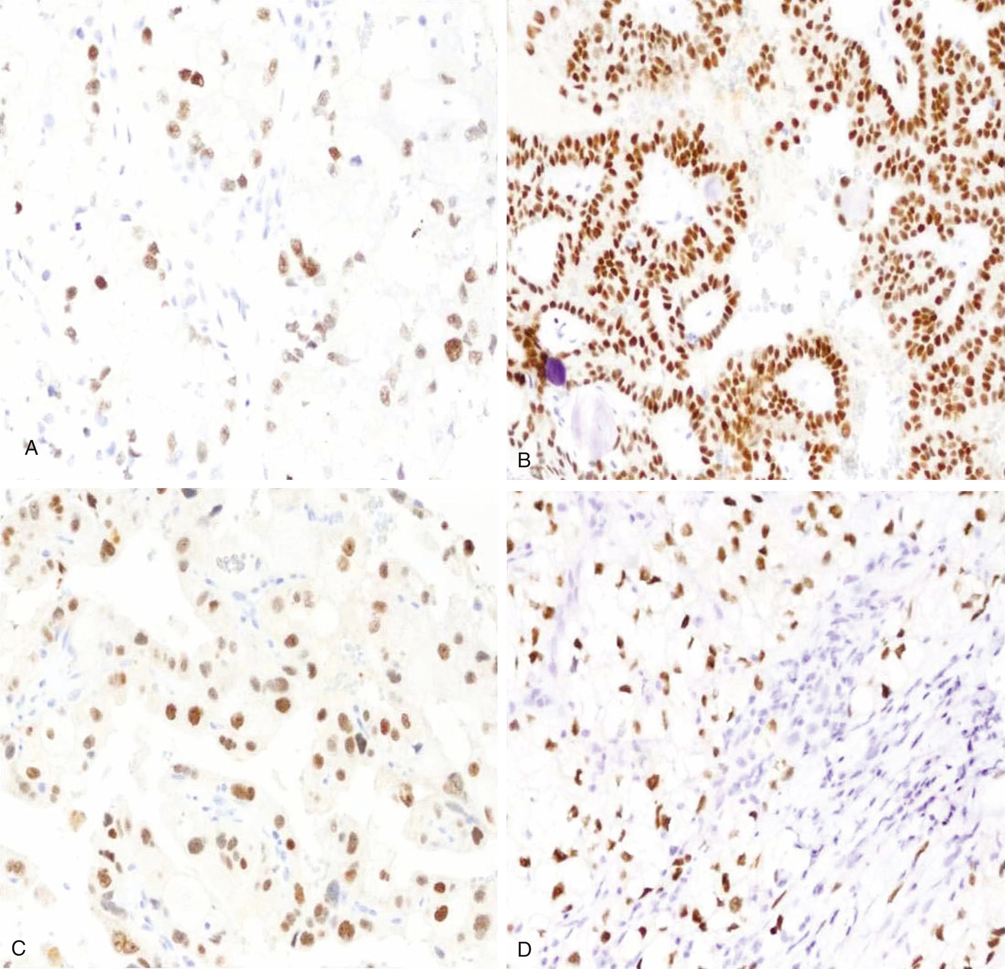 Fig. 17.18, PAX8 immunoexpression in primary clear cell renal cell carcinoma (CCRCC) (A), papillary RCC (B), chromophobe RCC (C), and metastatic CCRCC (D).