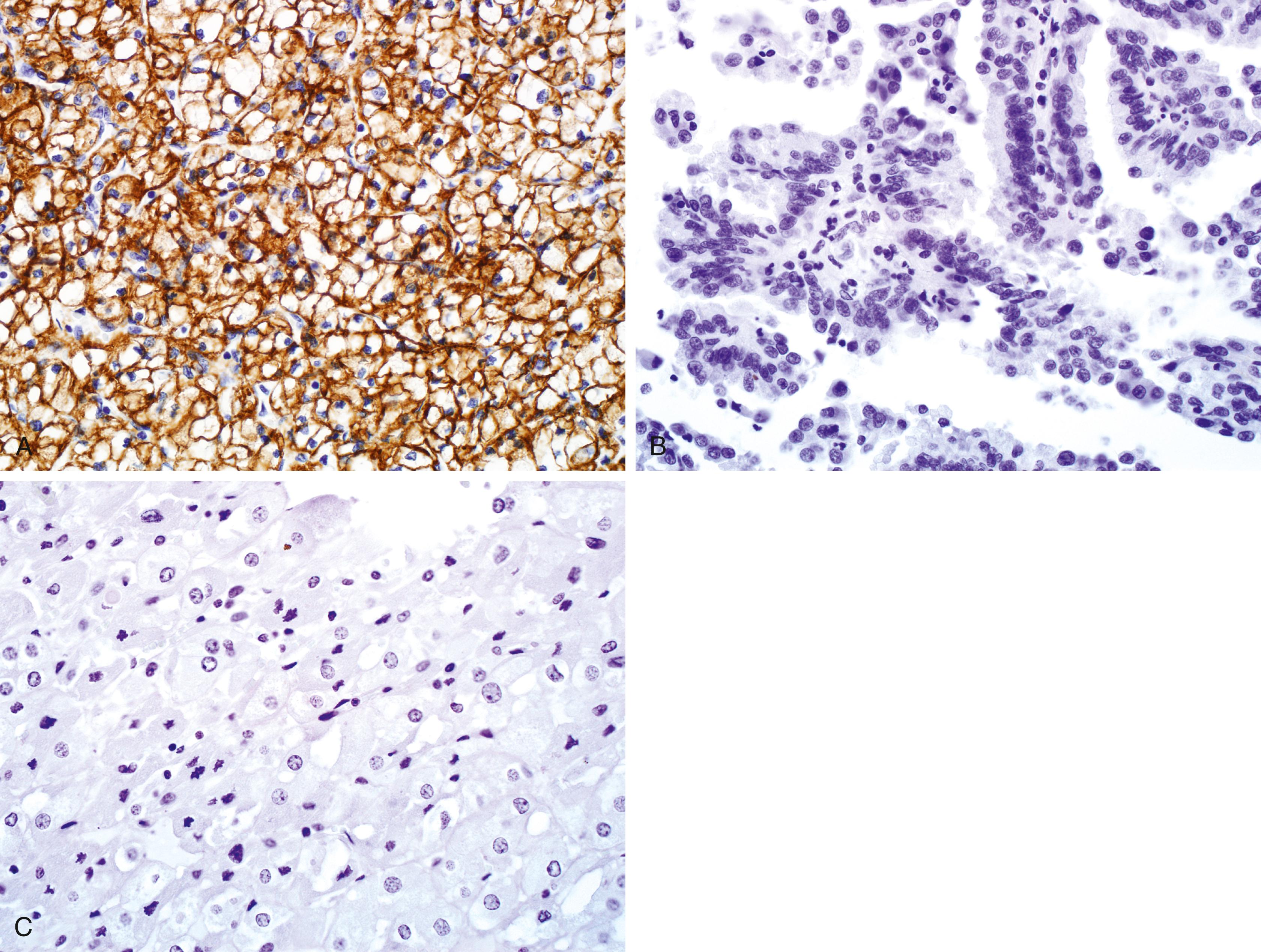 Fig. 17.19, (A) Carbonic anhydrase IX immunoexpression in clear cell renal cell carcinoma (CCRCC). Negative staining is encountered in papillary (B) and chromophobe RCC (C).