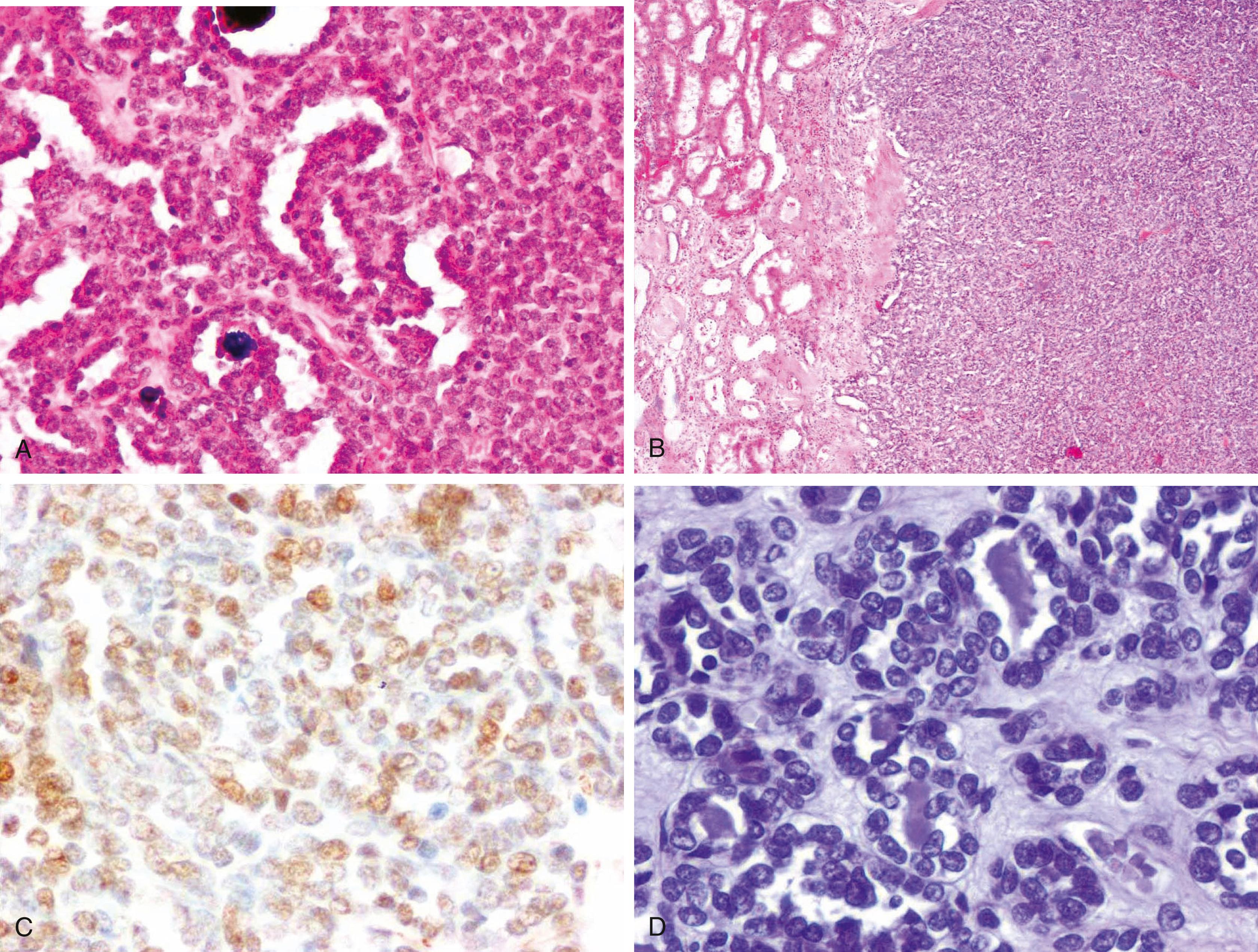 Fig. 17.20, Metanephric adenoma (A and B) showing positive nuclear staining for Wilms tumor 1 (C), with lack of cytokeratin 7 expression (D).