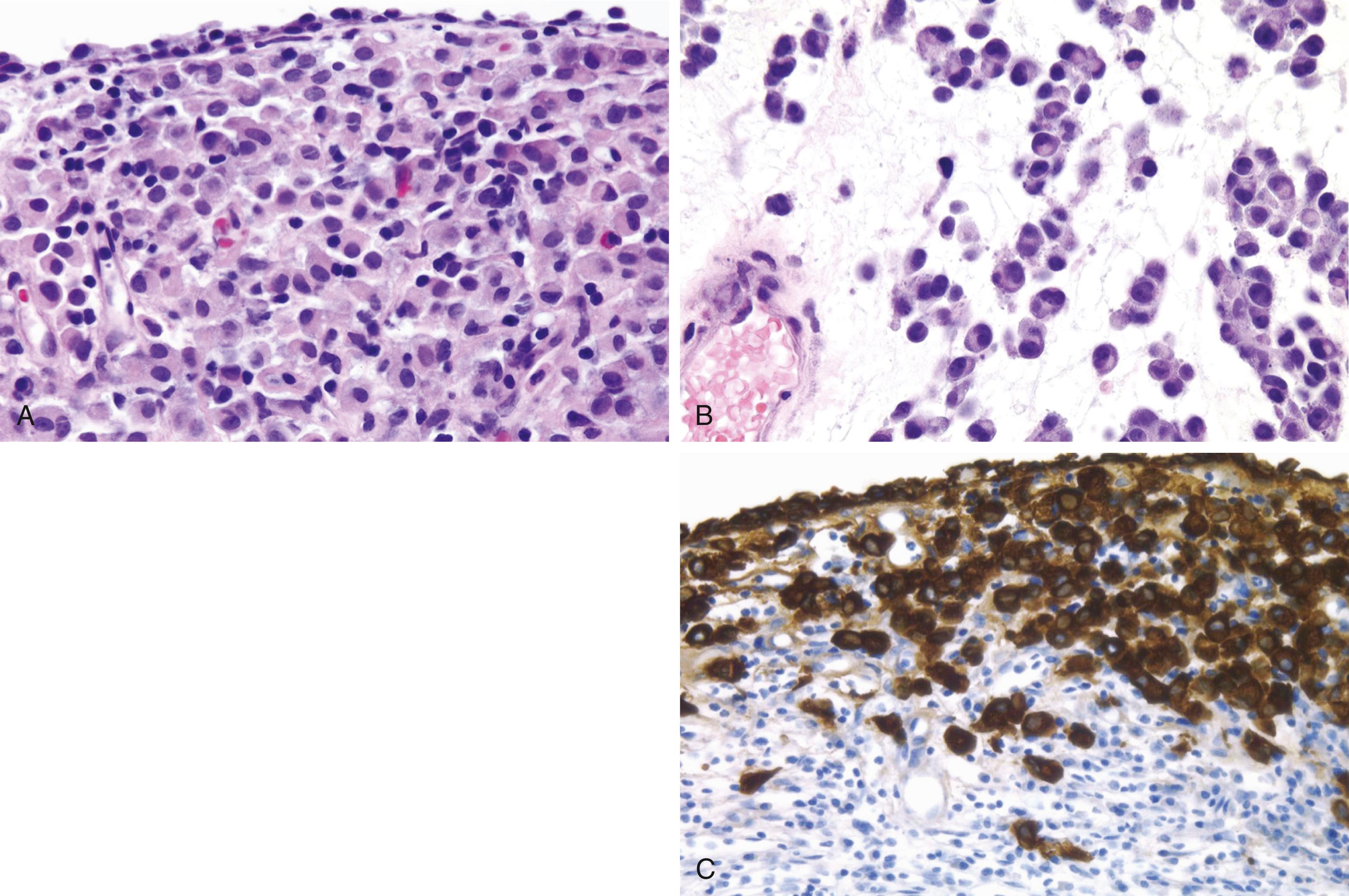 Fig. 17.3, (A and B) Plasmacytoid subtype of urothelial carcinoma. (C) High-molecular-weight cytokeratin highlights the tumor cells.