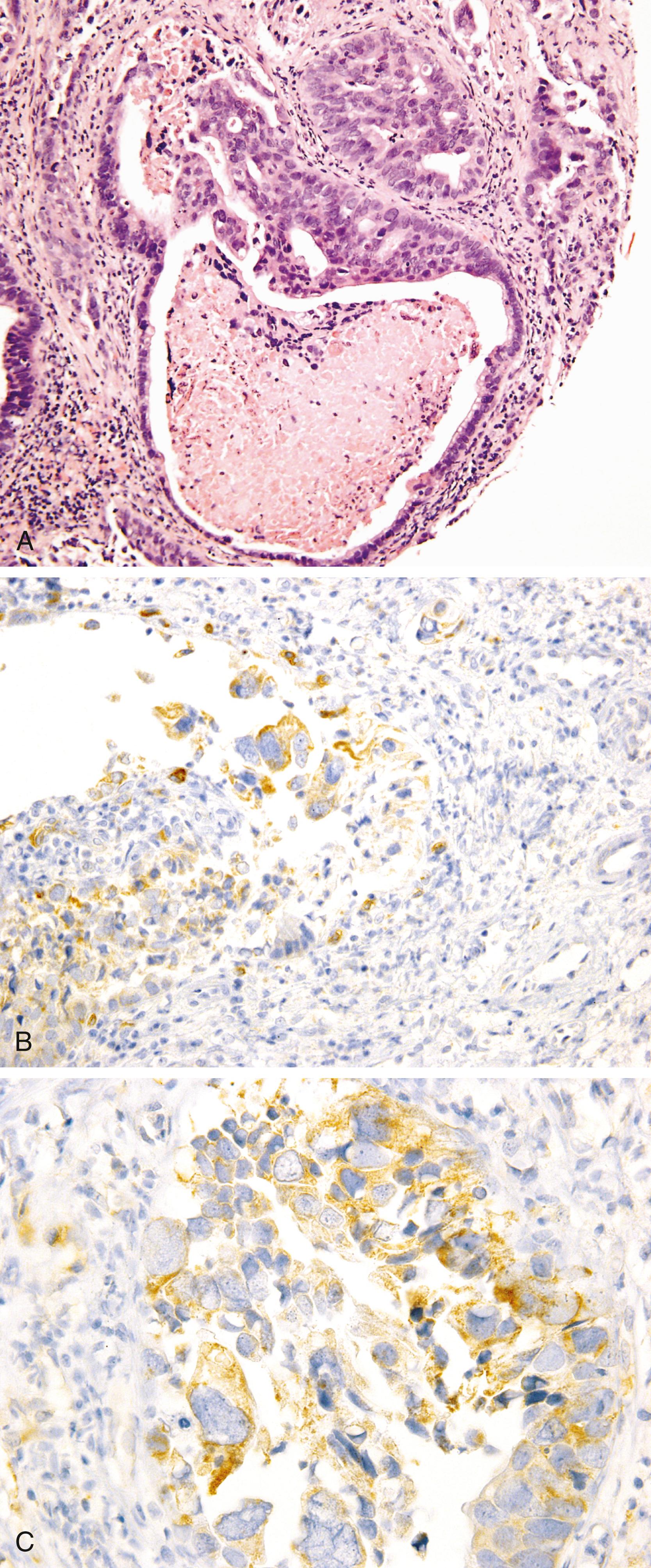 Fig. 17.4, Primary adenocarcinoma of urinary bladder (A) showing cytoplasmic positivity for prostate markers P501S (B) and prostate-specific membrane antigen (C).