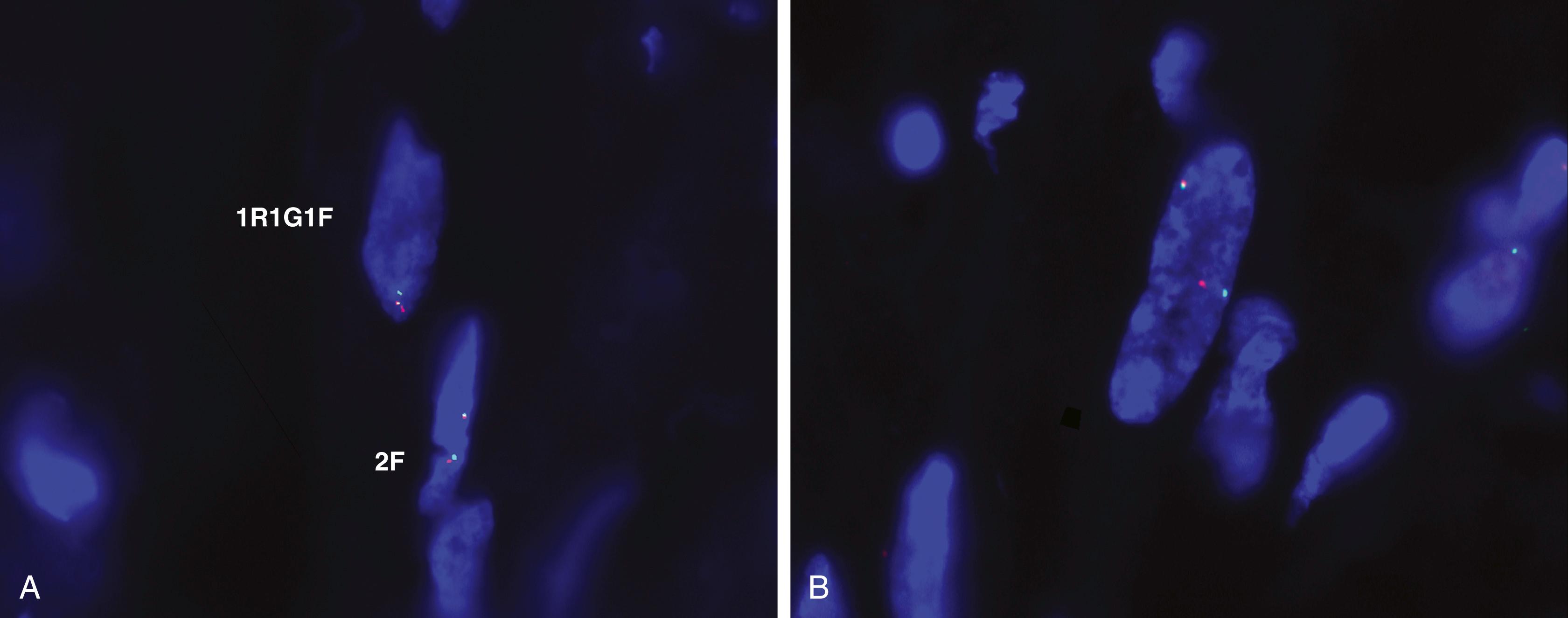 Fig. 17.6, (A and B) Interphase fluorescence in situ hybridization analysis for ALK1 gene in inflammatory myofibroblastic tumor by using split-apart probes. The presence of a set of one green and one red signal in addition to a juxtaposed red-green (yellow overlap) set indicates a rearrangement in one of the two ALK1 alleles.