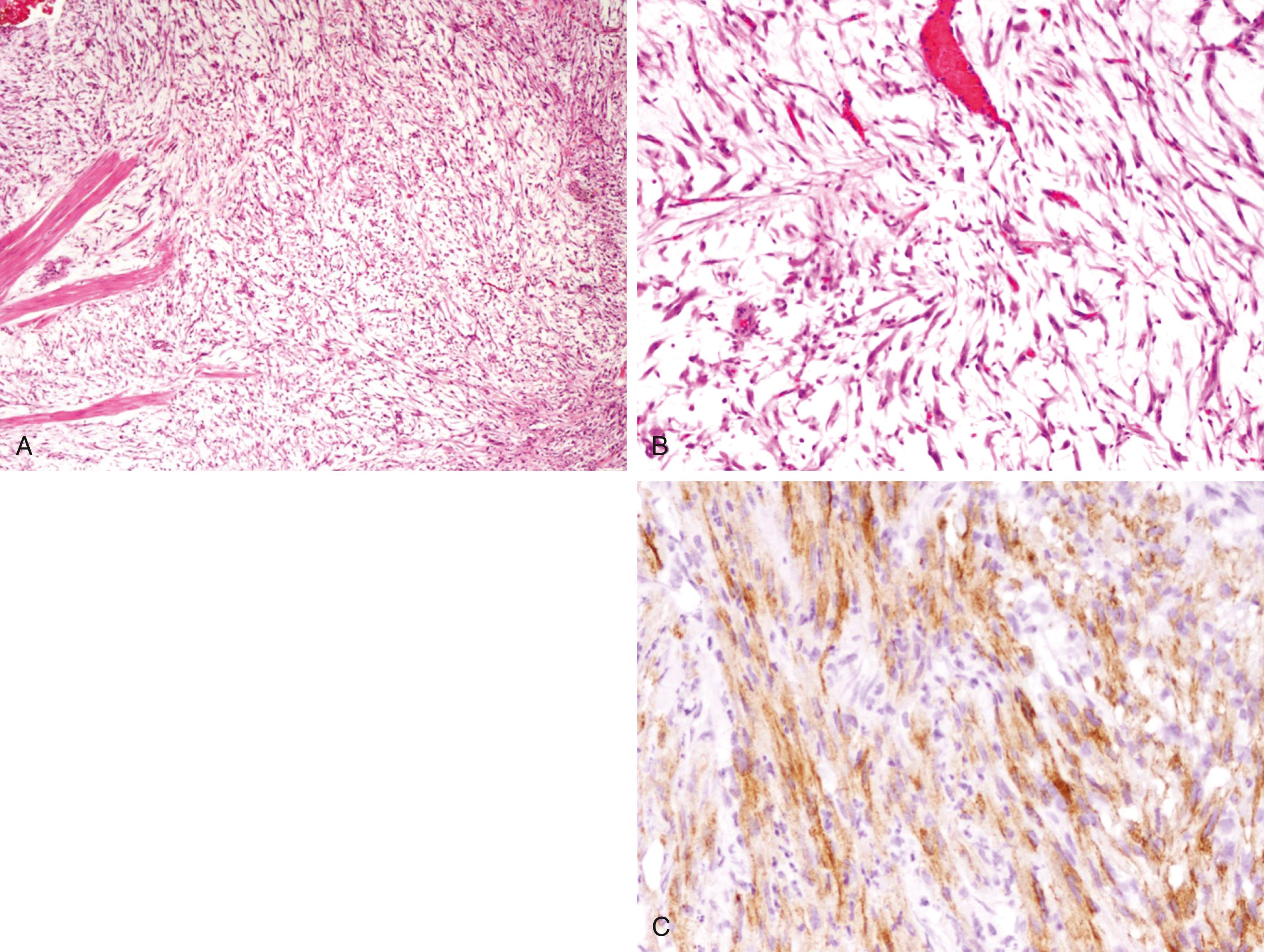 Fig. 17.7, (A and B) Inflammatory myofibroblastic tumor of the urinary bladder. (C) Positive ALK1 staining is shown.