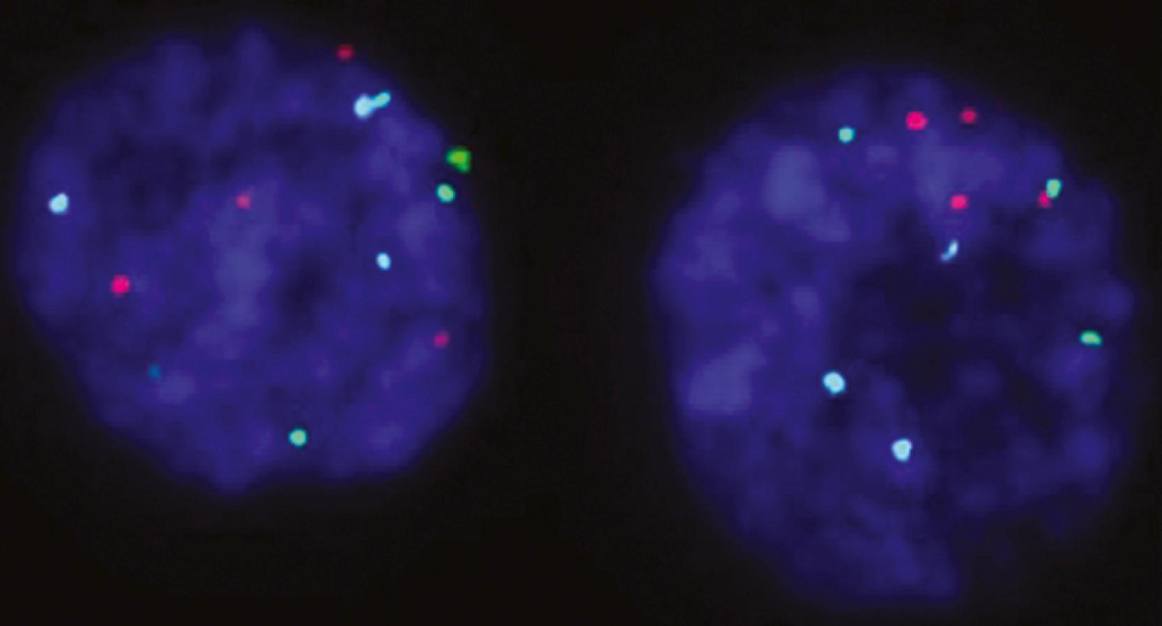 Fig. 17.10, Interphase fluorescence in situ hybridization urine cytology analysis by using Vysis UroVysion probe sets (Abbott Molecular, Abbott Park, IL) for chromosomes 3q (red) , 7p (green) , and 17q (aqua) and 9p21 deletions (p16 locus: gold ). Note polysomy for 17q (aqua) and deletion of 9p21 loci (absence of gold signals) in two urothelial carcinoma cells.