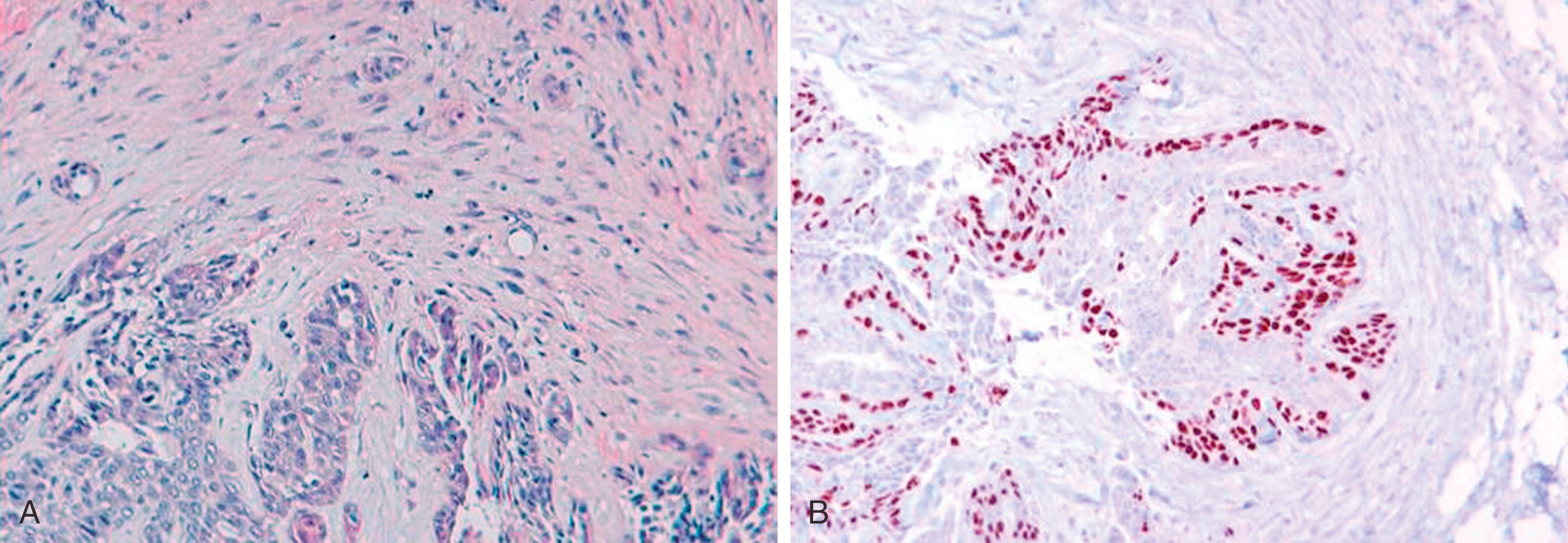 Fig. 19.11, Edge of sclerosing papillary lesion (A). A p63 stain confirms absence of invasion (B).