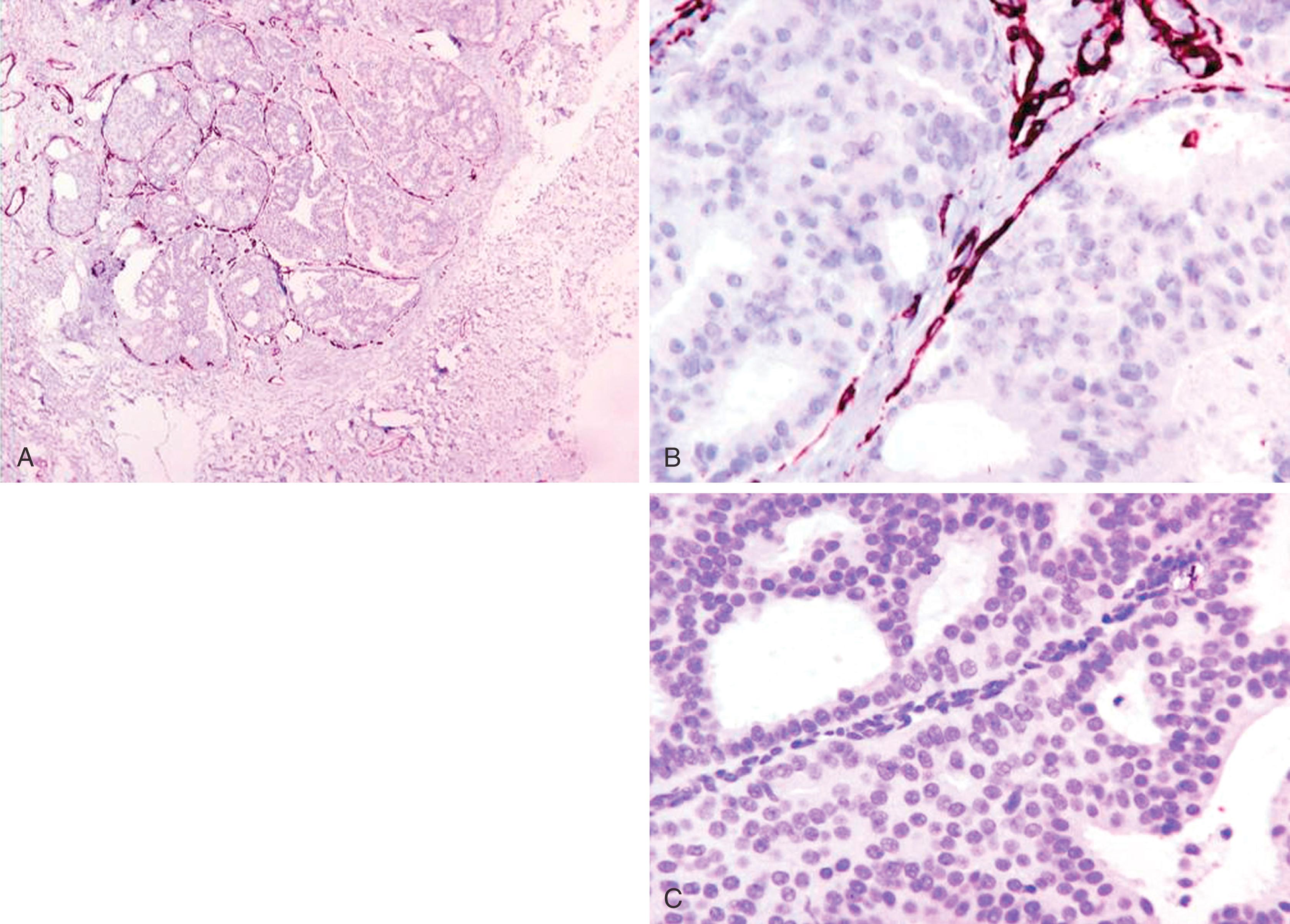 Fig. 19.13, Initial microscopic impression of tumor nest is that myoepithelial cells are present, manifested by the presence of smooth muscle myosin heavy chain (A). Closer inspection reveals staining of vessels (note lumens) around tumor nests (B). No immunostaining for p63 documents lack of myoepithelial cells in this case (C).