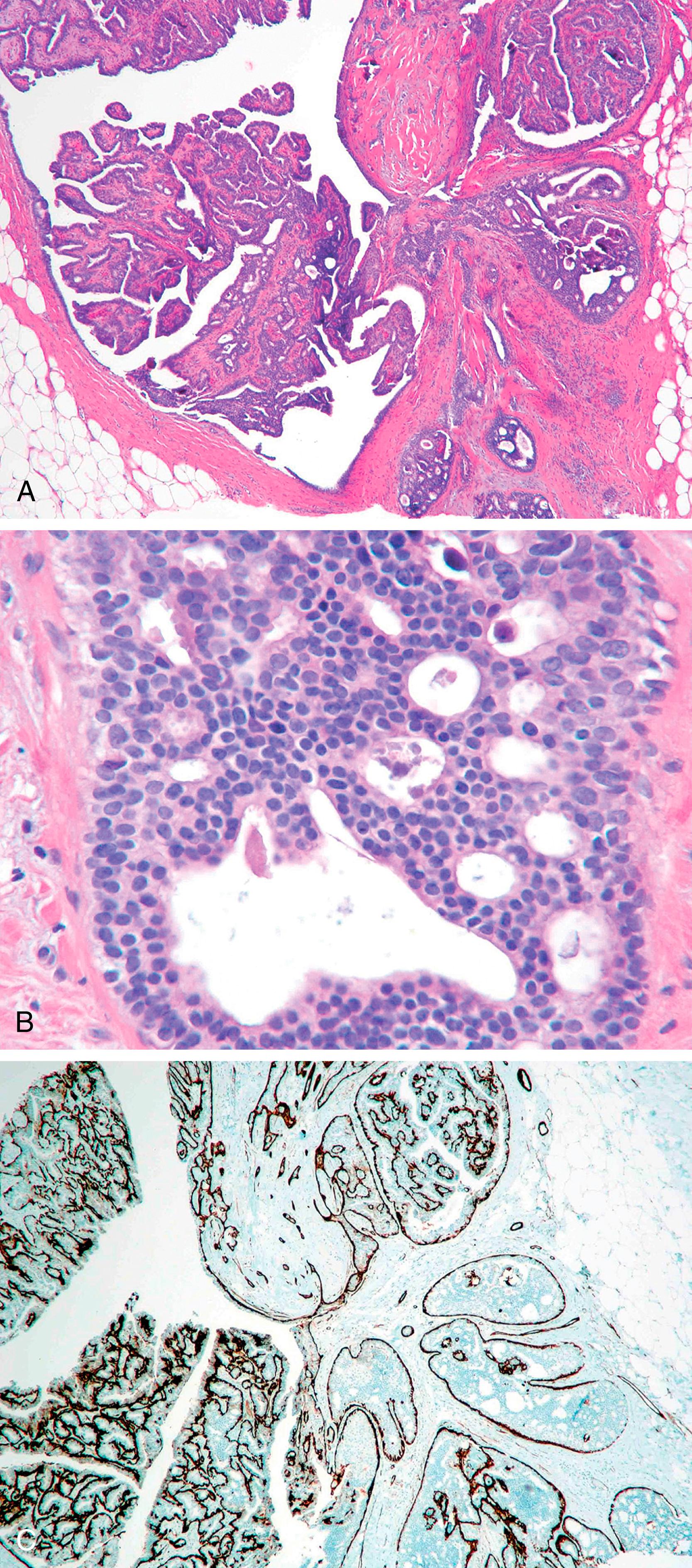 Fig. 19.14, A low-power view of an intraductal papilloma with monomorphic cellular proliferation at the bottom right (A). A high-power view demonstrates the presence of ductal carcinoma in situ (DCIS) in a papilloma (B). A lack of smooth muscle myosin heavy chain immunostaining in this morphologically abnormal area confirms the diagnosis of DCIS involving papilloma (C).