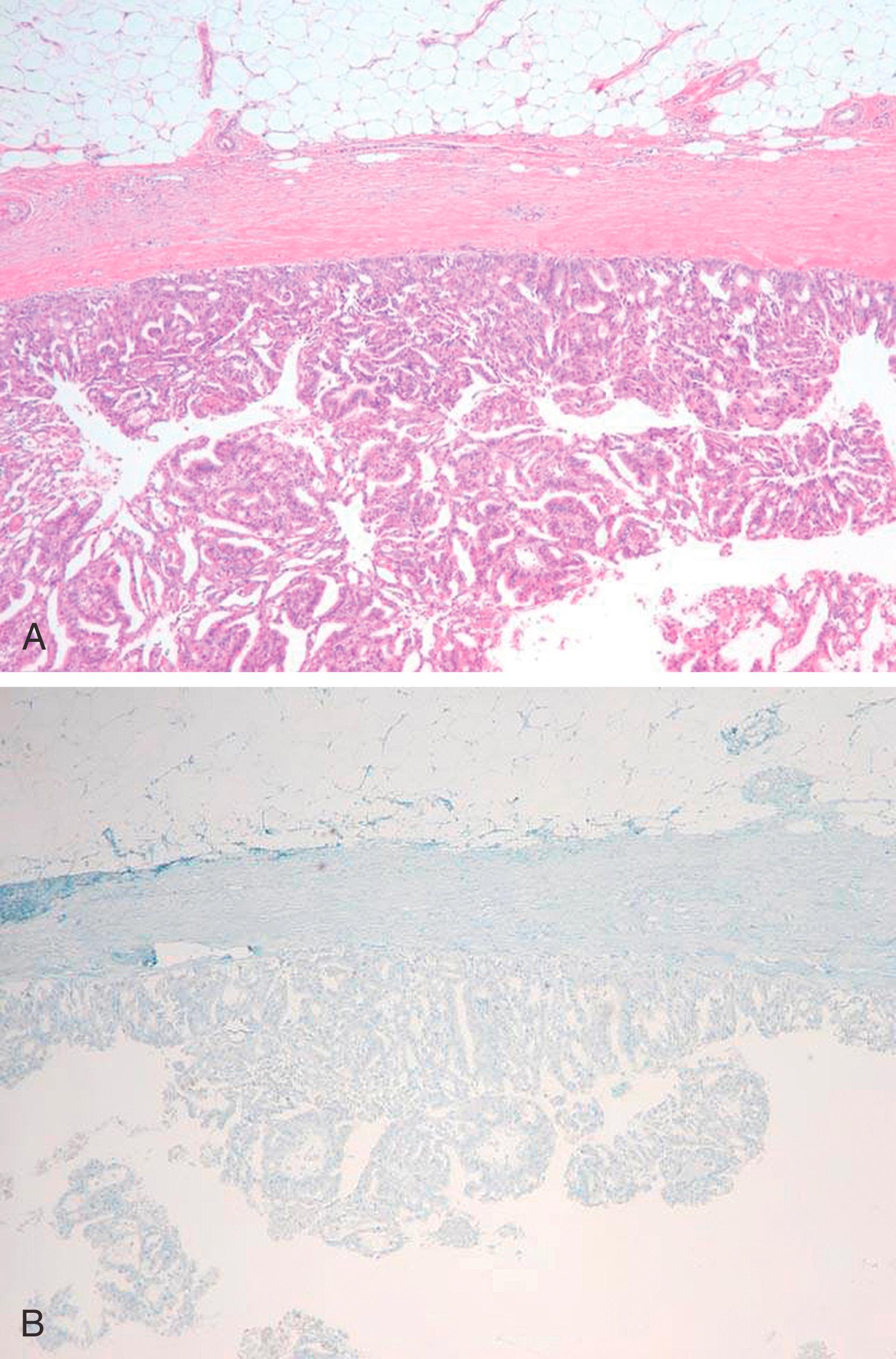 Fig. 19.15, An intracystic (encapsulated) papillary carcinoma (A), with lack of p63 staining at the periphery of the lesion (B).