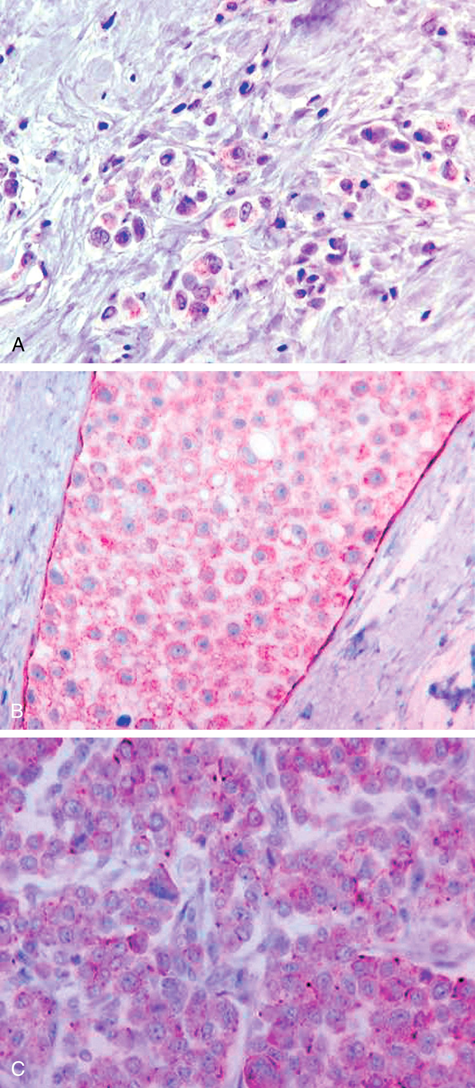 Fig. 19.19, Aberrant staining with E-Cadherin (ECAD)-Cytoplasmic ECAD staining in invasive lobular carcinoma (A) and lobular carcinoma in-situ (B). An example of “dot-like” ECAD staining in invasive carcinoma (C).