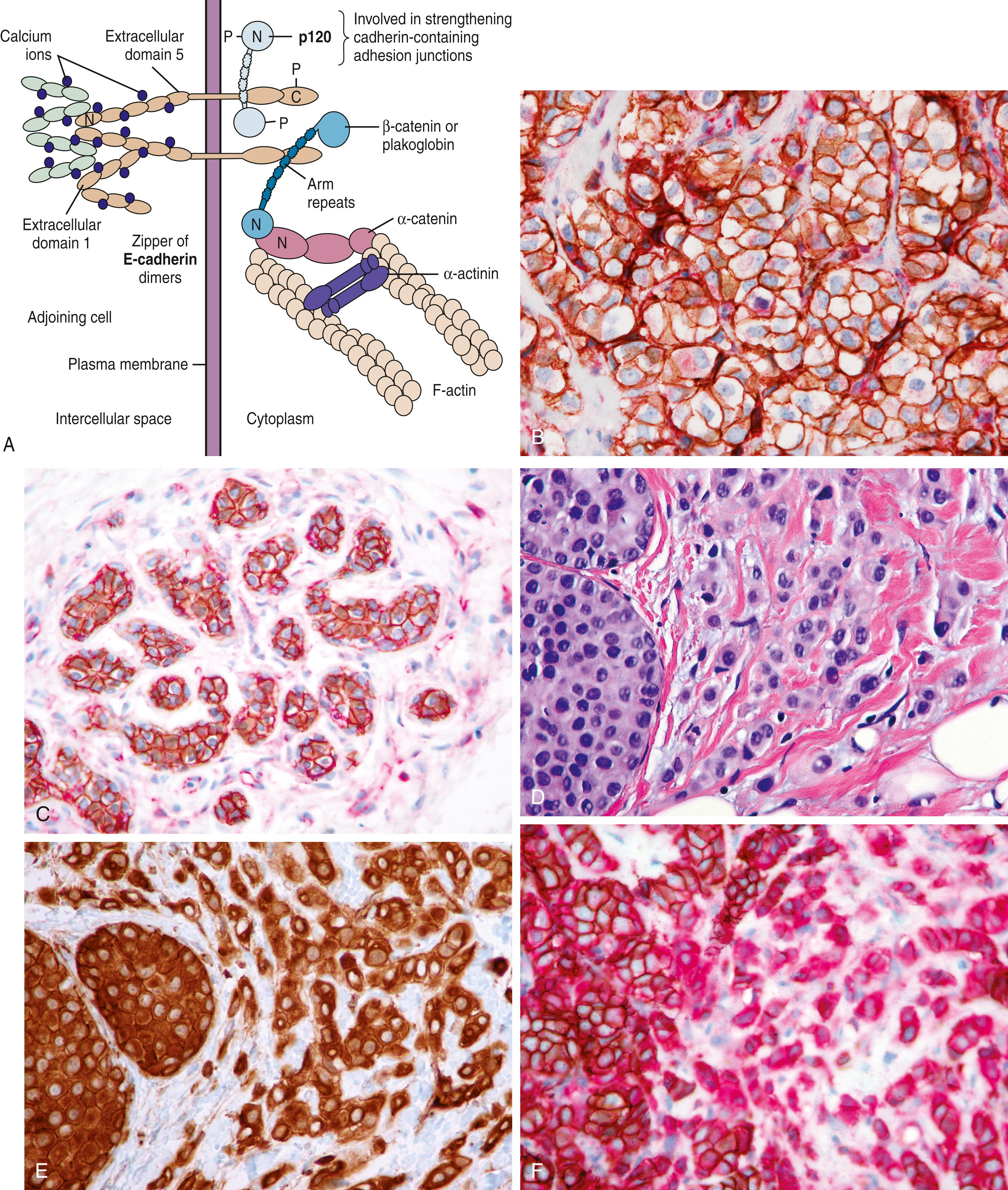 Fig. 19.20, Diagrammatic representation of E-Cadherin (ECAD) relationship to p120 (A). The dynamic biology of ECAD-p120 can be illustrated using a dual ECAD (brown) -p120 (red) stain (B and C). In this example of invasive ductal carcinoma, strong membranous reactivity (reddish-brown) is identified for both ECAD and p120 (B). Similar reddish-brown membranous staining is identified in acinar cells within this lobule (C). An example of invasive and in-situ lobular carcinoma (D) demonstrating strong cytoplasmic immunoreactivity for p120 using a single color stain (E). A dual ECAD-p120 stain demonstrating membranous ECAD and p120 (reddish-brown) immunoreactivity in the ductal component with lack of ECAD (absence of brown staining) but strong cytoplasmic p120 (red) staining in this example of mixed ductal and lobular carcinoma (F).