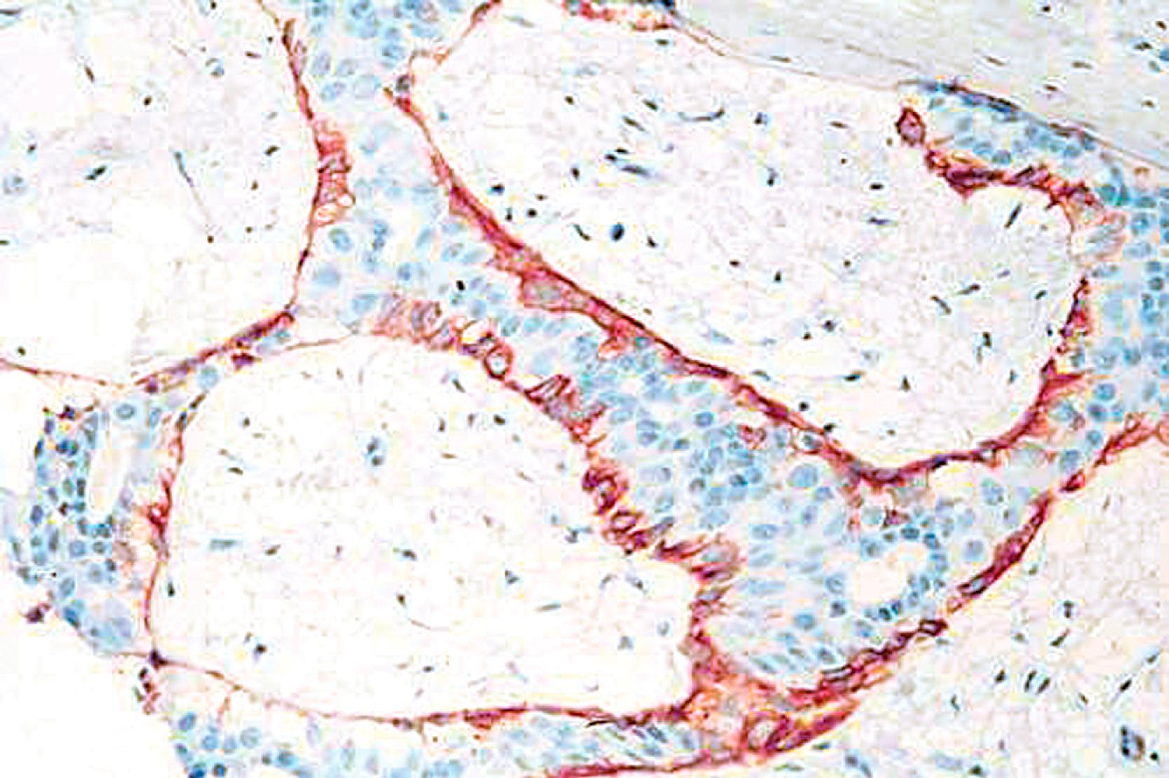 Fig. 19.2, Smooth muscle myosin heavy chain stains myoepithelial cells in a fibroadenoma.