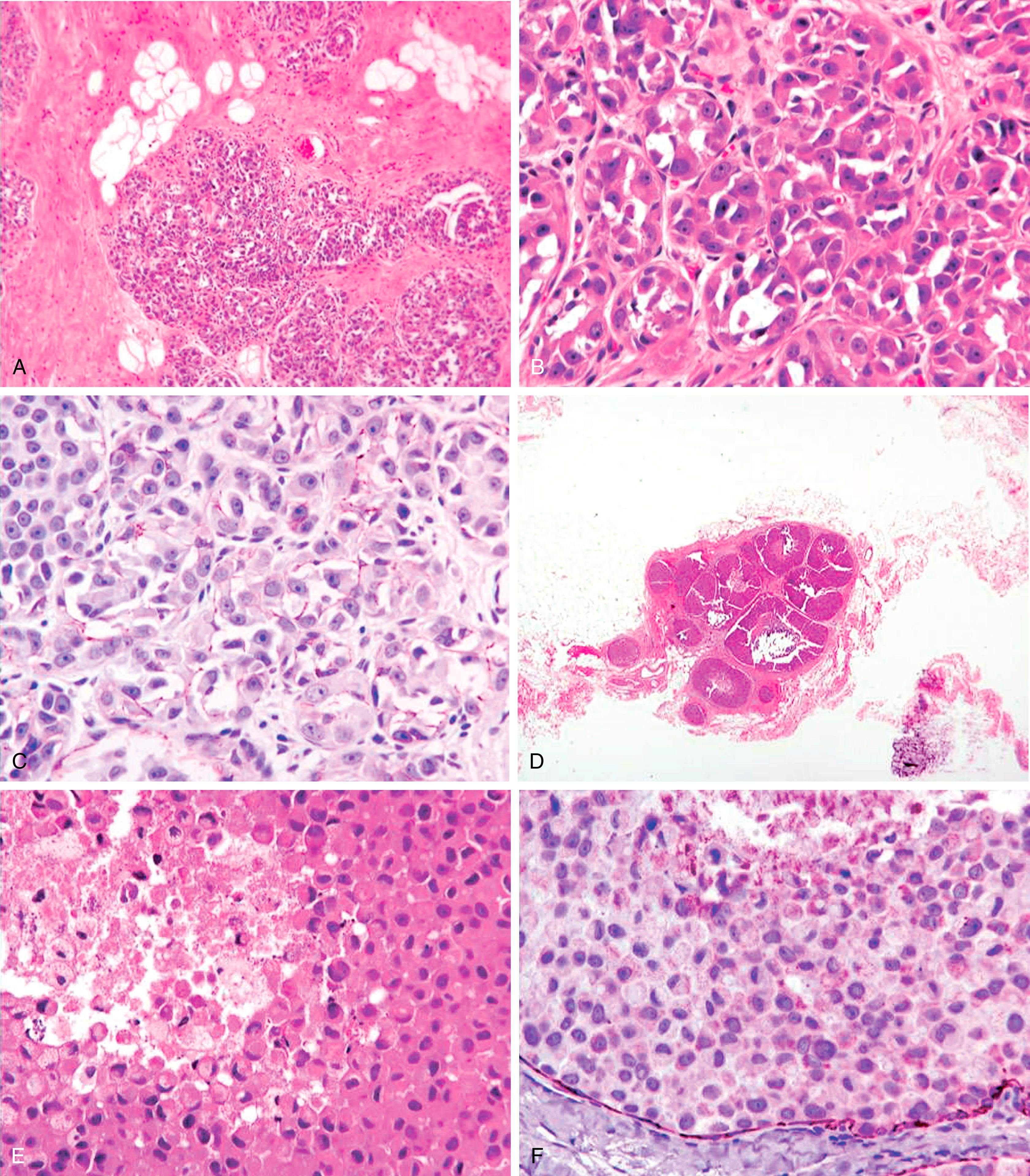 Fig. 19.22, Pleomorphic LCIS (PLCIS) in lobular arrangement showing nuclear grade 3 and prominent nucleoli (A and B). PLCIS is E-Cadherin (ECAD) negative (C). Low magnification of PLCIS with comedonecrosis and calcification simulating DCIS (D). Note the dyshesion and plasmacytoid cellular features characteristic of PLCIS (E). ECAD is negative in PLCIS and positive in myoepithelial cells (F).