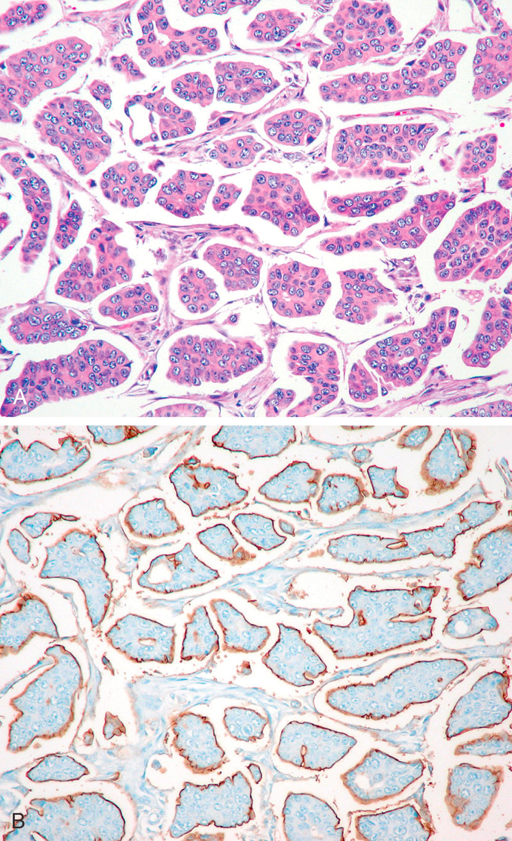 Fig. 19.24, An invasive micropapillary carcinoma of the breast (A) demonstrating “reverse polarity” of the neoplastic cells by epithelial membrane antigen (EMA) (B). Note the intense staining by EMA at the stroma-facing side of the cells.