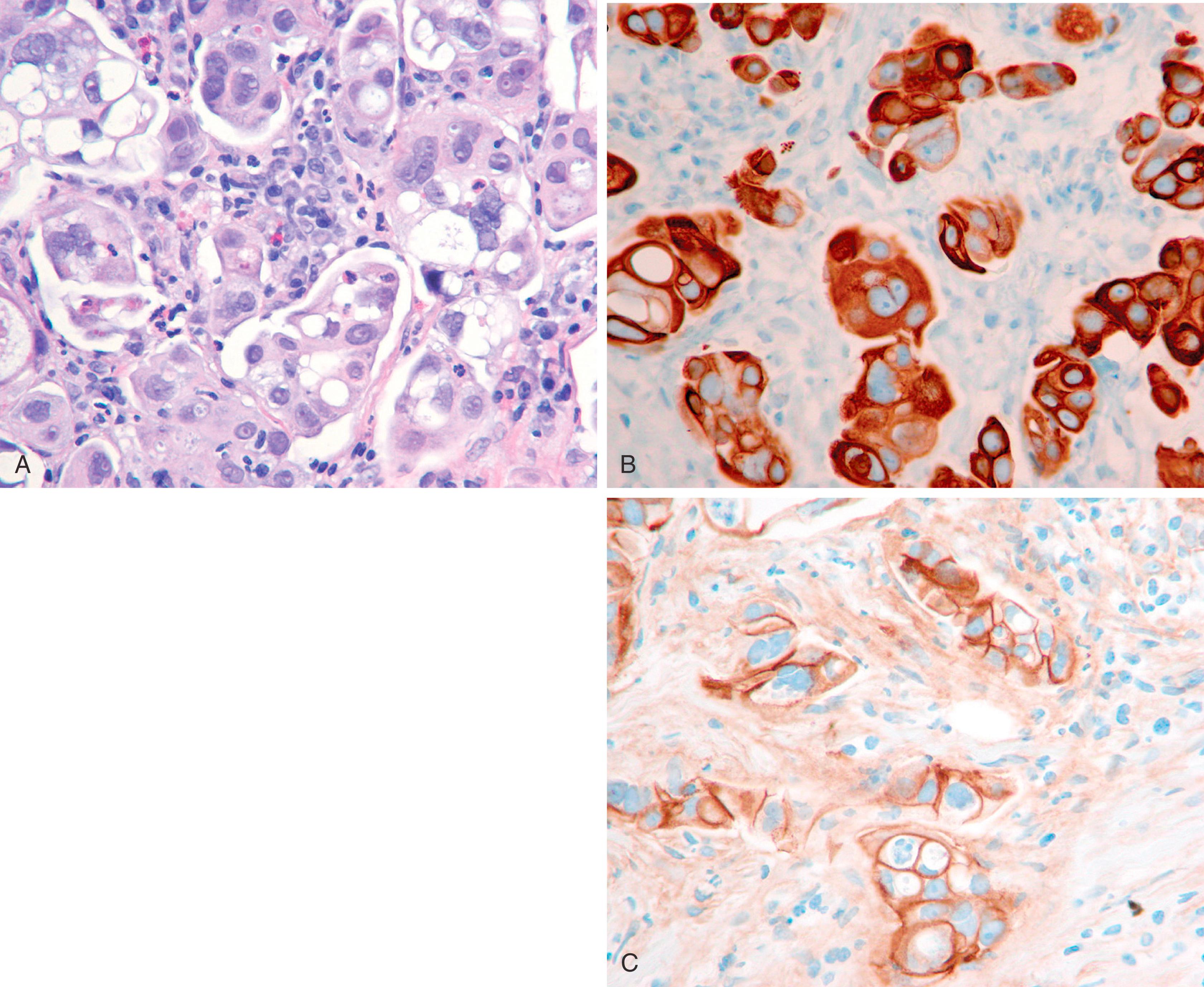 Fig. 19.25, A “basal-like” carcinoma (A) demonstrating immunoreactivity for CK5/6 (B) and epidermal growth factor receptor (C).