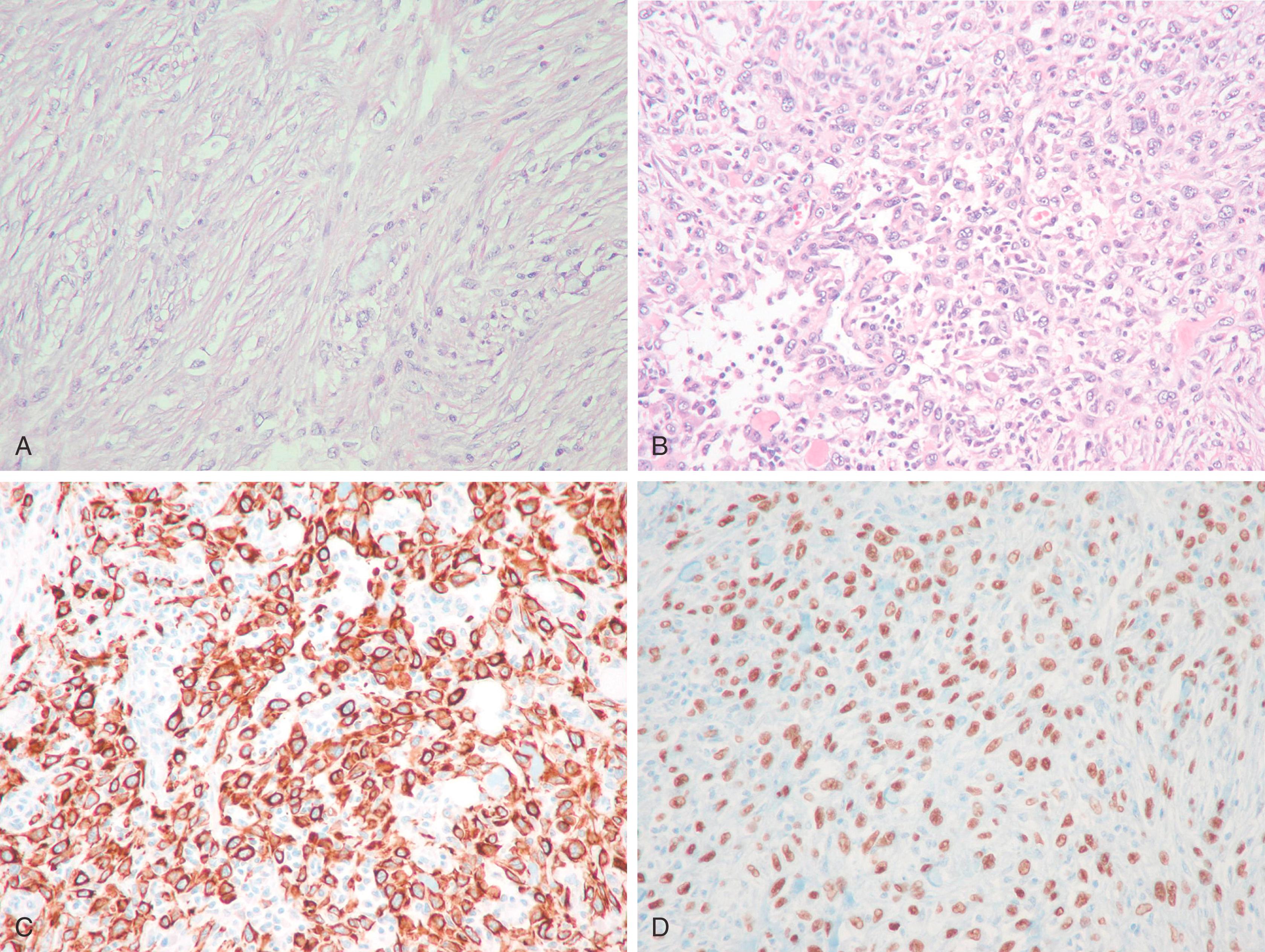 Fig. 19.26, This predominantly spindle cell neoplasm (A) showed only a focal area of epithelioid malignant cells (B). The tumor was completely negative for AE1/3 and CAM5.2, but demonstrated staining for basal cytokeratins (CK5/6, CK14, CK17) and p63 (C and D respectively) supporting the diagnosis of spindle cell metaplastic carcinoma.