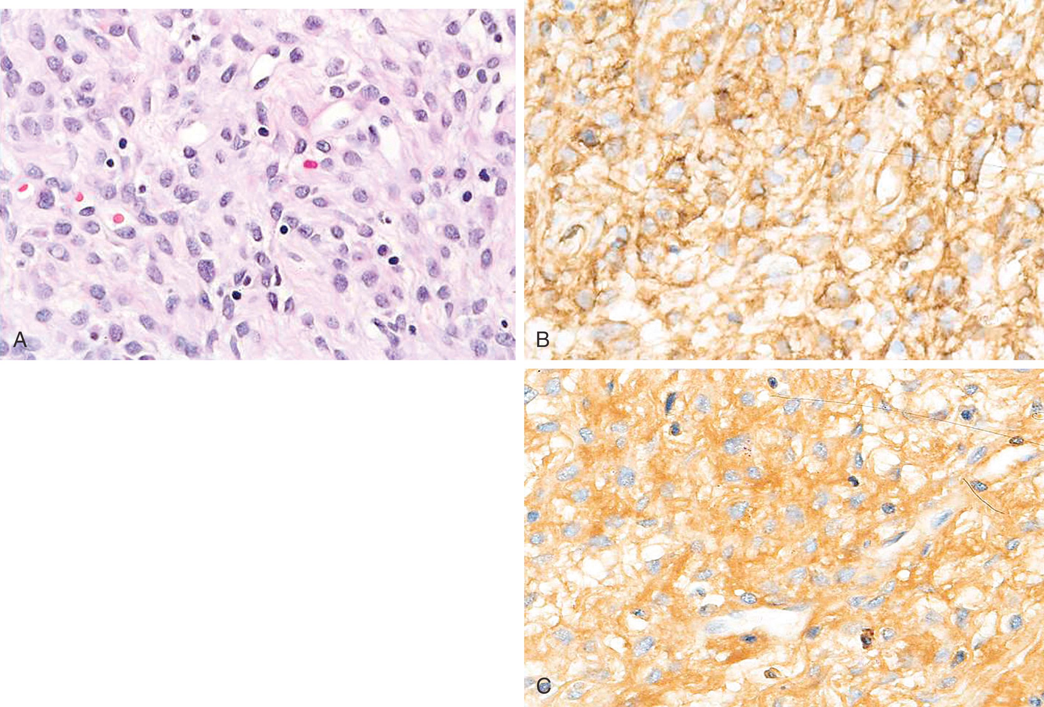 Fig. 19.27, Myofibroblastoma of breast (A) typically shows the presence of desmin (B) and muscle-specific actin (HHF-35) (C).