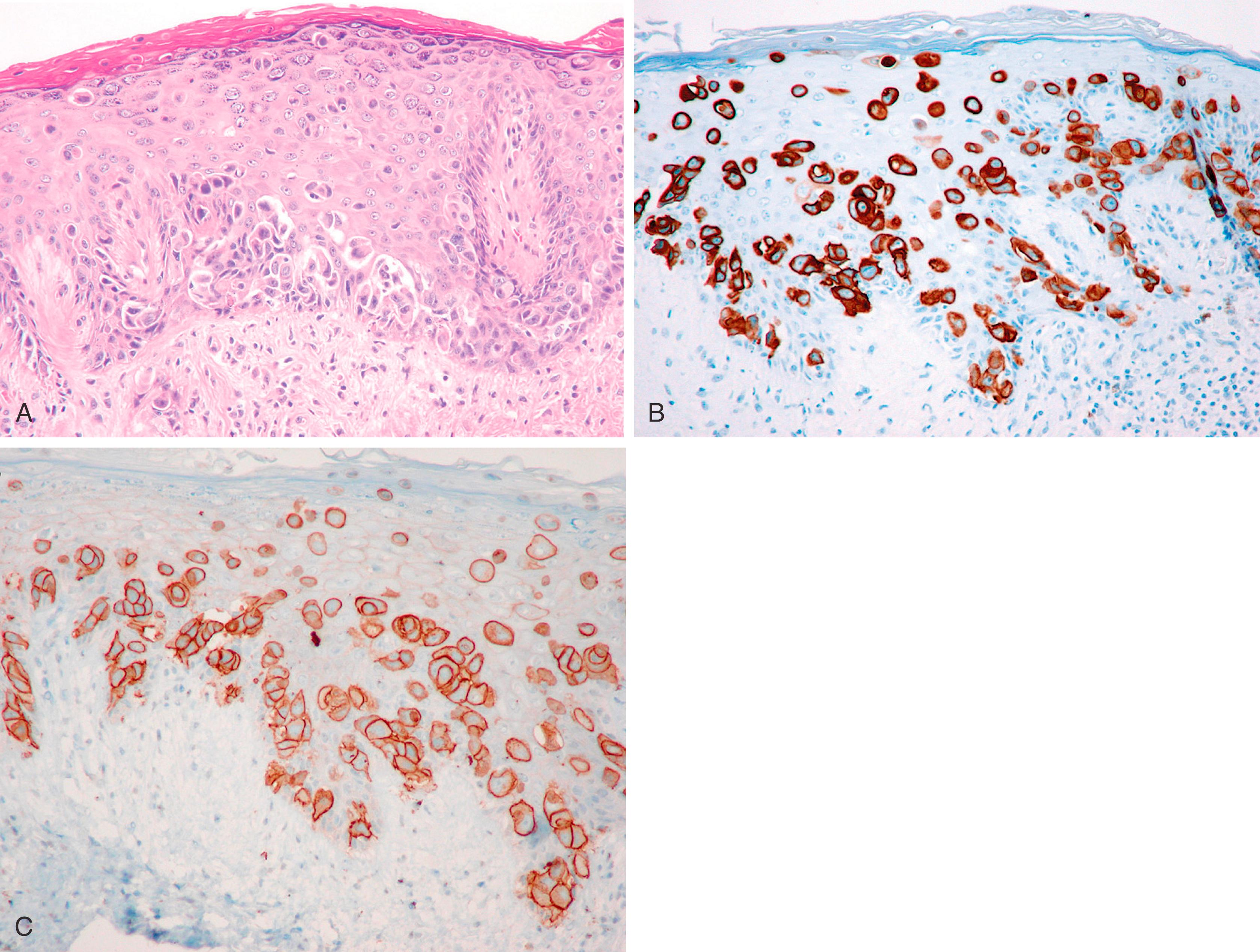 Fig. 19.28, Paget disease of the nipple (A), showing strong staining with antibodies to CK7 (B) and HER2 (C).