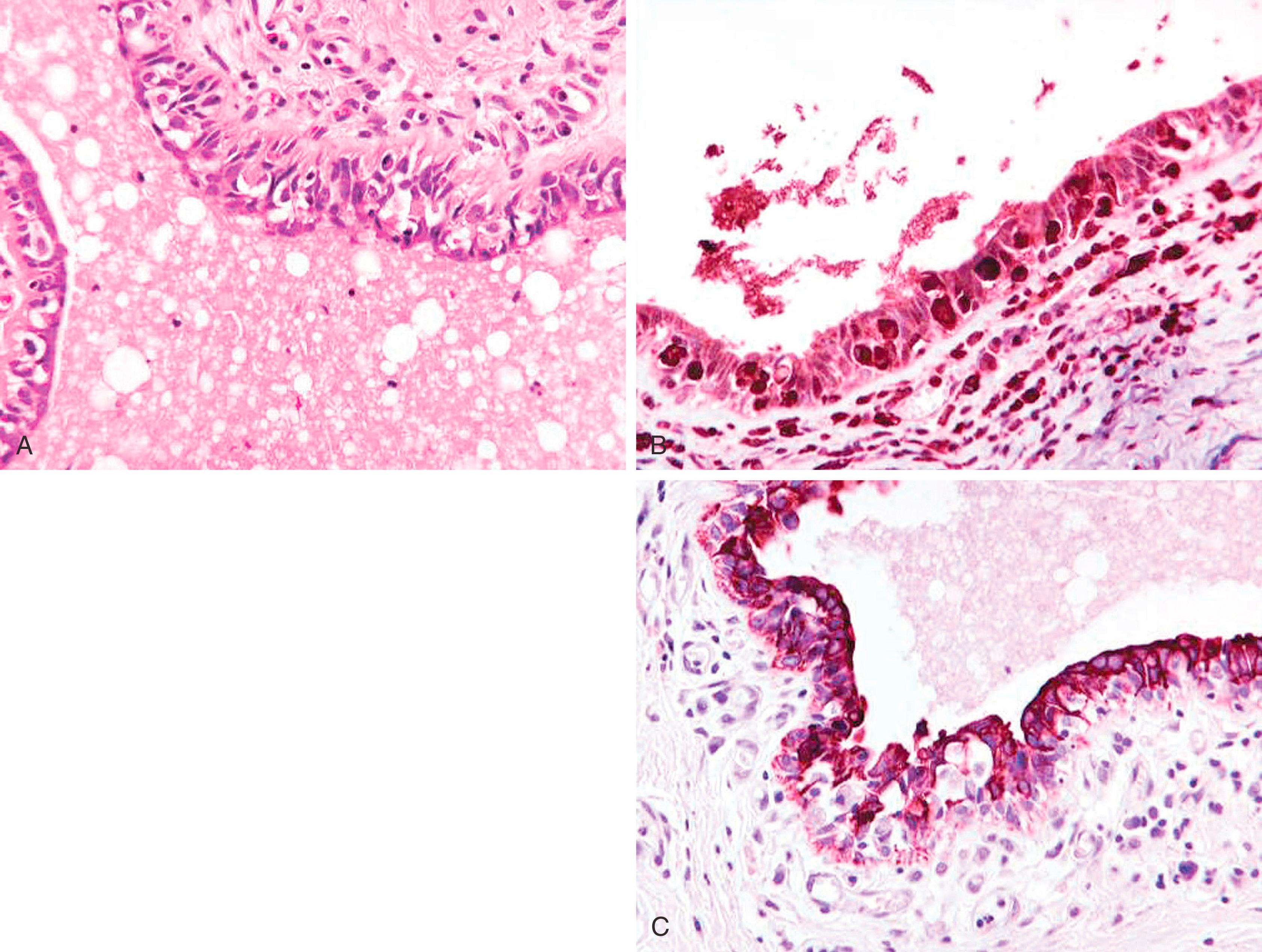 Fig. 19.29, Duct ectasia with pseudopaget of large ducts (A). Large clear cells intercalated in duct epithelium are CD68 positive (B) and CK7 negative (C).