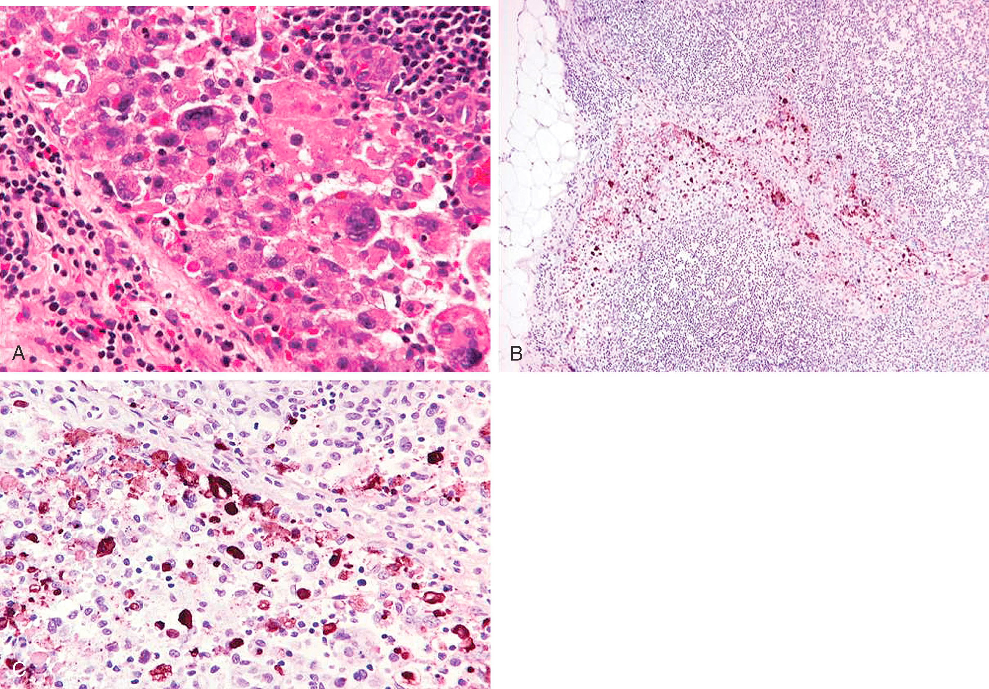 Fig. 19.32, Possible “benign transport”-Sentinel lymph node sinus with giant cells, macrophages, broken red blood cells, and epithelioid cells (A). Low magnification of keratin+ cells involving the lymph node sinus (B). Higher magnification showing mixture of keratin+ cells with debris of macrophages and degenerated red blood cells (C).