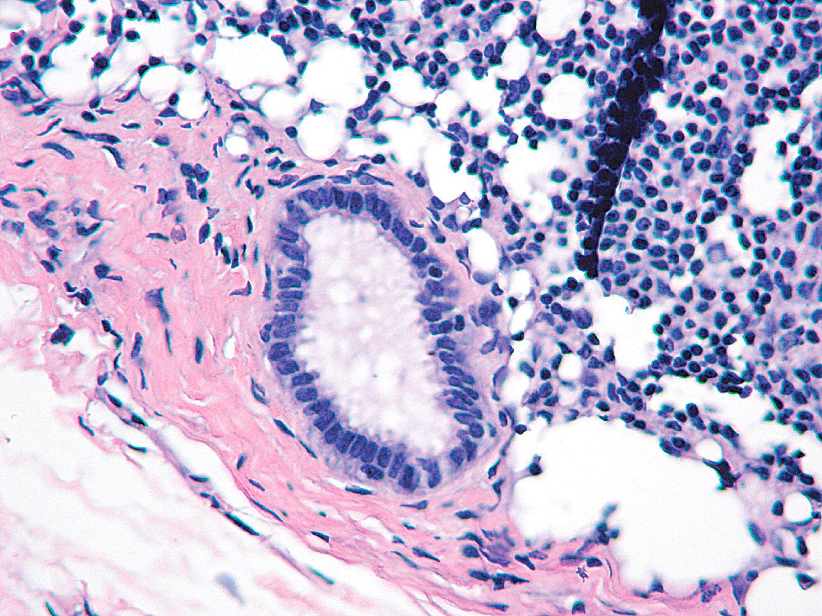 Fig. 19.33, A benign epithelial glandular inclusion in an axillary lymph node as shown here may result in a false positive molecular test for assessing micro-metastatic disease.