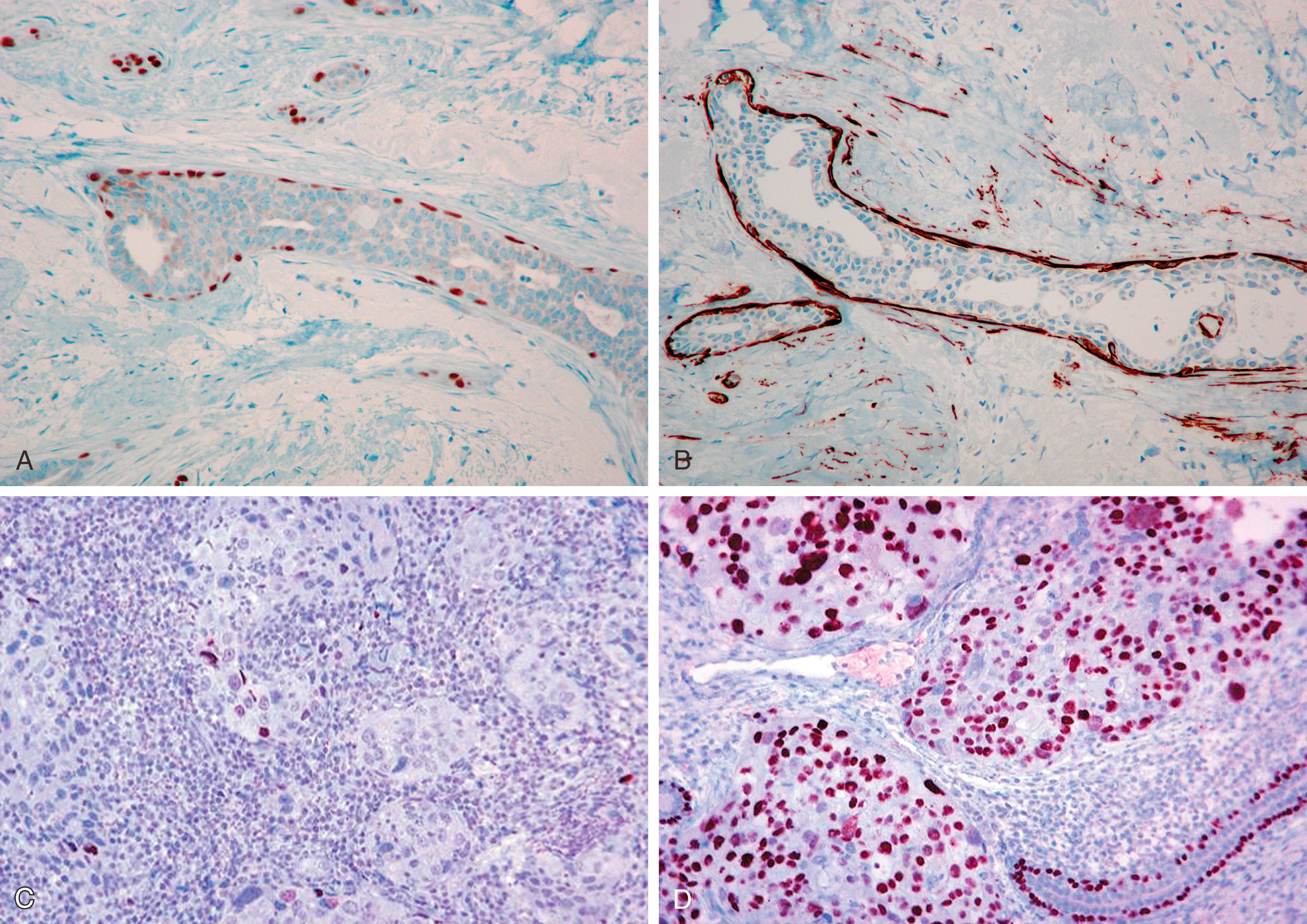 Fig. 19.7, Pitfalls of p63 and smooth muscle myosin heavy chain. A p63 stain demonstrates apparent gaps in staining around the luminal epithelium of a duct within a radial scar (A). Same duct shows intense continuous staining with smooth muscle myosin heavy chain, but myofibroblastic cells in the background are also positive (B). A p63 stain on core biopsy shows staining of few tumor cells (C). A rare example of diffuse p63 staining of tumor cells (D).