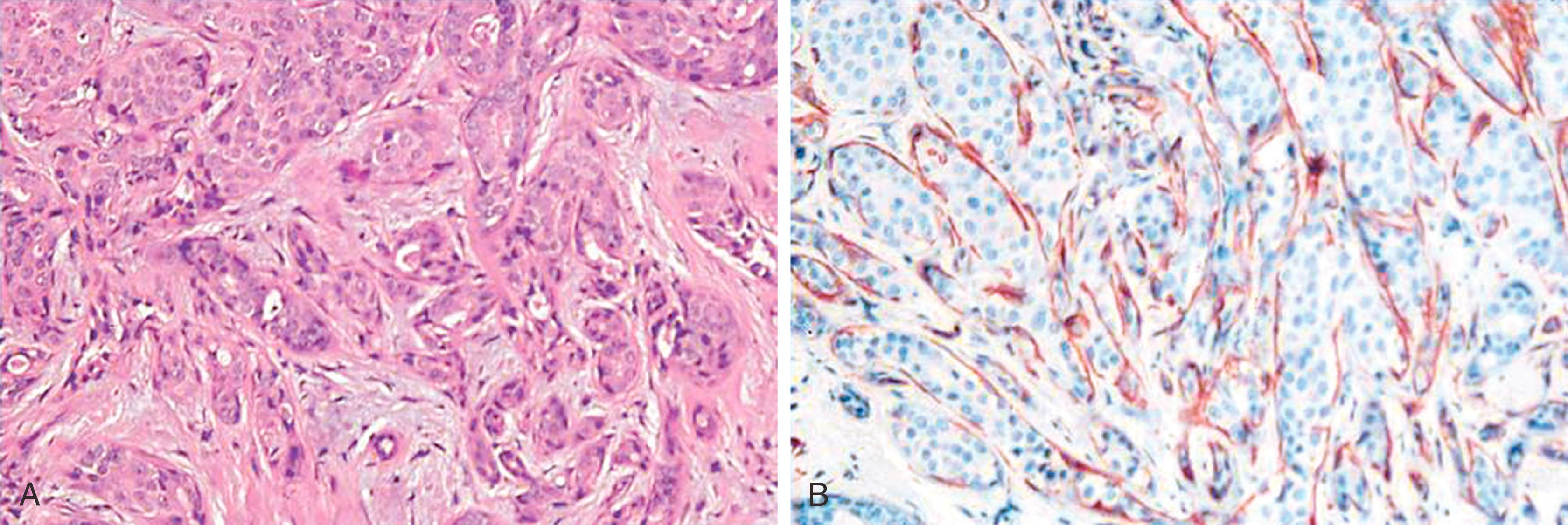 Fig. 19.8, Sclerosing adenosis may simulate carcinoma (A) but demonstrates envelopment of cell nests by myoepithelial cells with smooth muscle myosin heavy chain immunostaining (B).