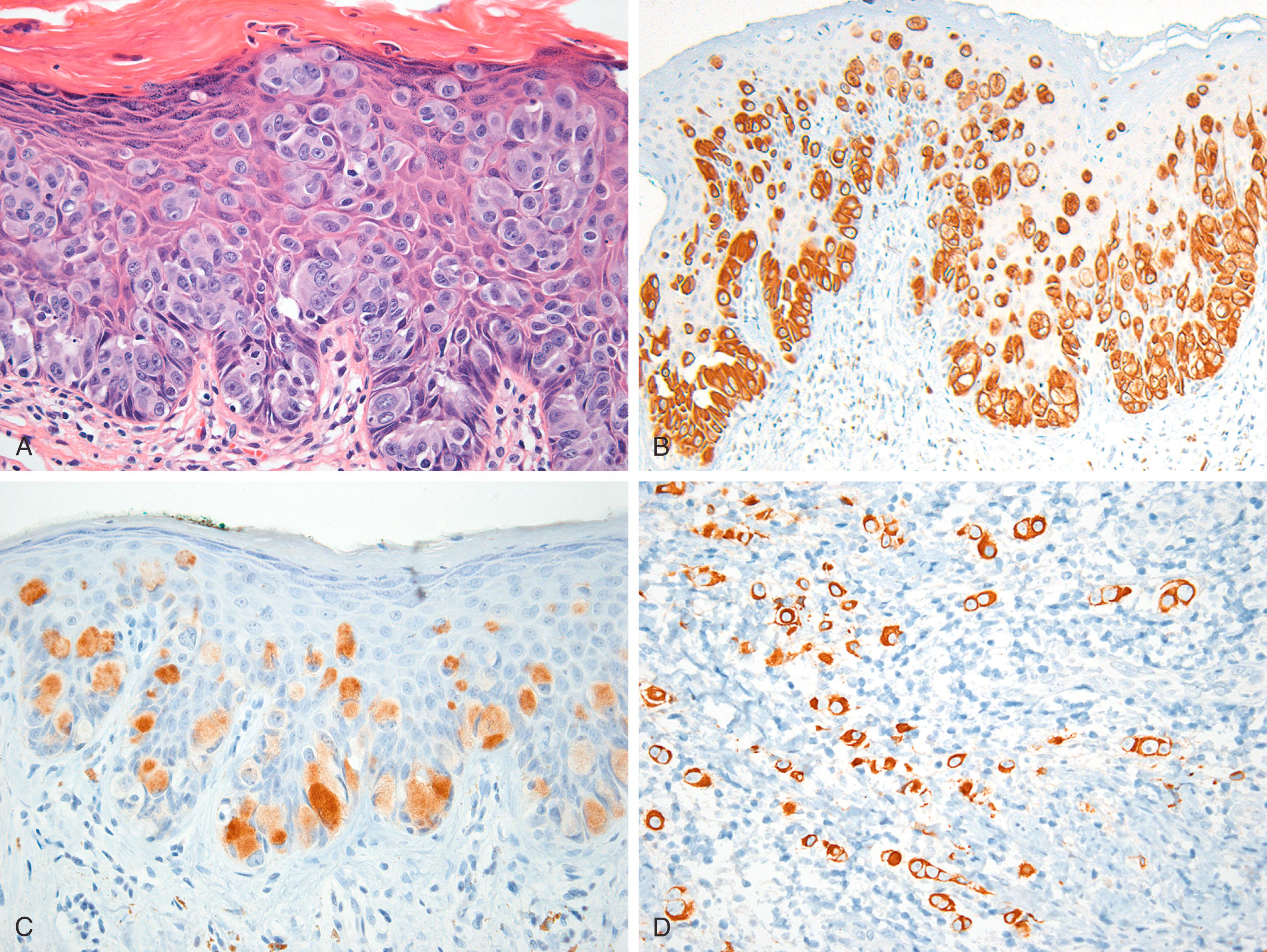 Fig. 18.1, (A) Primary vulvar Paget disease (hematoxylin and eosin). Tumor cells express cytokeratin 7 (CK7; B) and gross cystic disease fluid protein (C), but normal epithelium does not. Occult stromal invasion can be highlighted by CK7 (D) when inflammation obscures the epidermal-dermal junction.