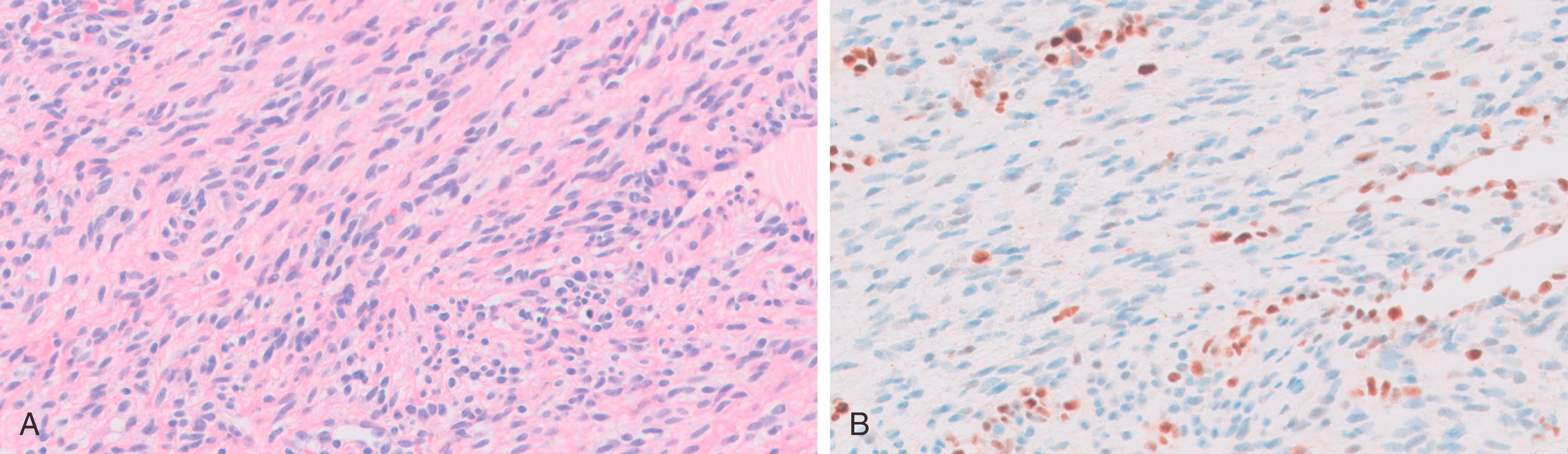 Fig. 18.2, (A) Vulvar cellular angiofibroma (hematoxylin and eosin). (B) Tumor cells show loss of Rb by immunohistochemistry.