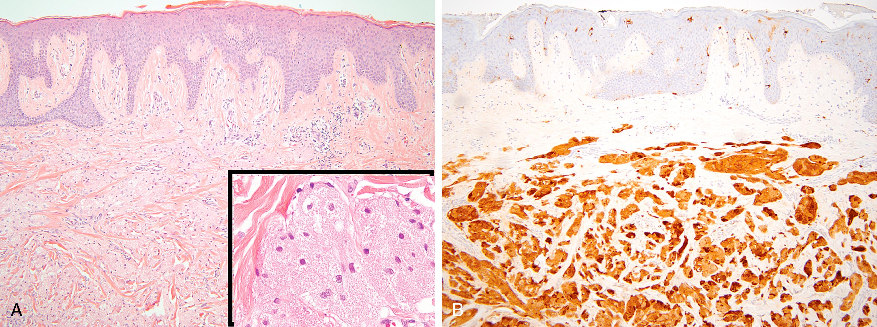 Fig. 18.3, (A) Vulvar granular cell tumor (hematoxylin and eosin). Tumor cells ( inset ) express S100 (B), calretinin, and inhibin (not shown).