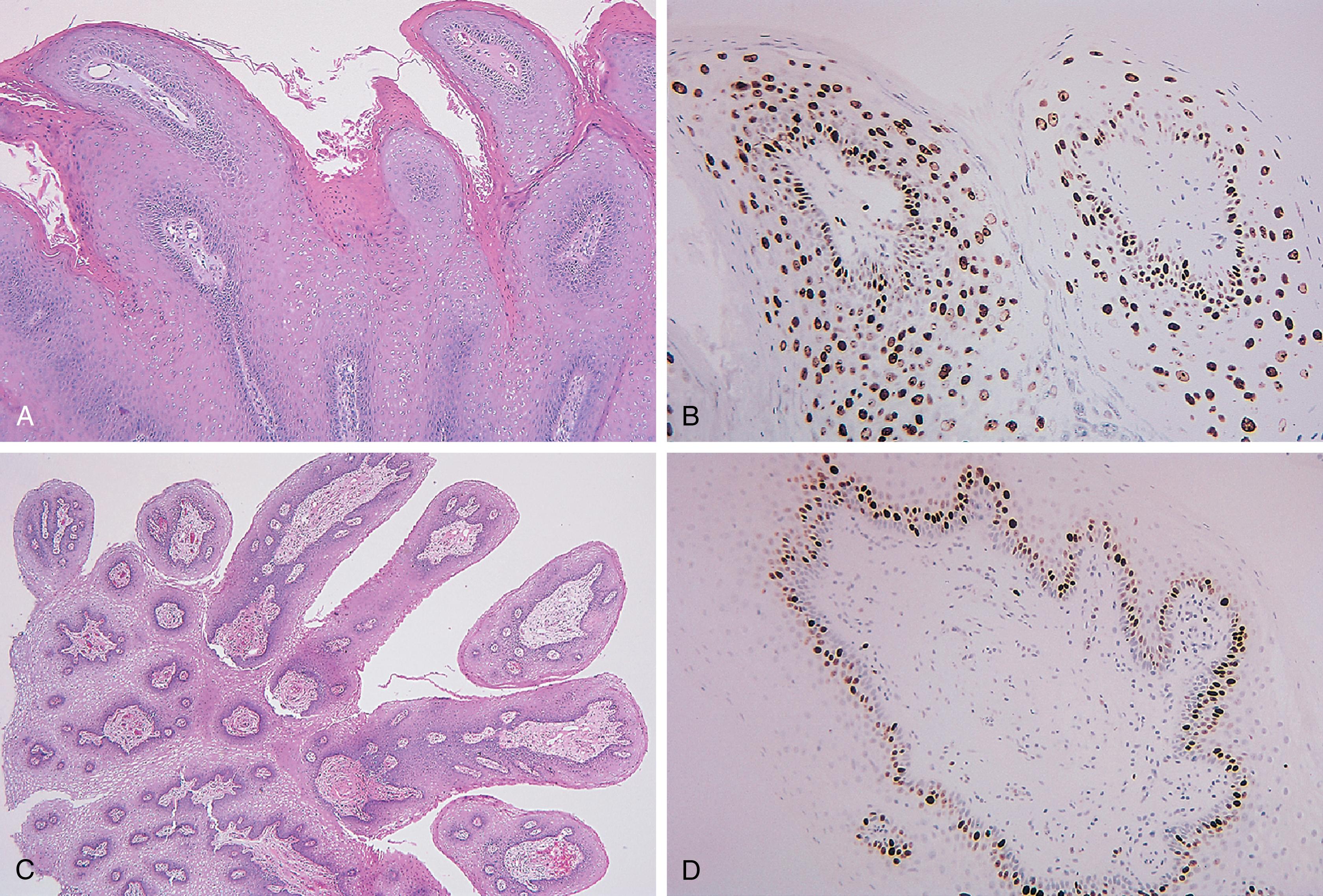 Fig. 18.4, In exophytic vulvar lesions, molecular immunology Borstel 1 (MIB-1) is expressed above the basal layer in condyloma (A and B) but is confined to parabasal cells in squamous papilloma (C and D) and in fibroepithelial polyp (E and F).