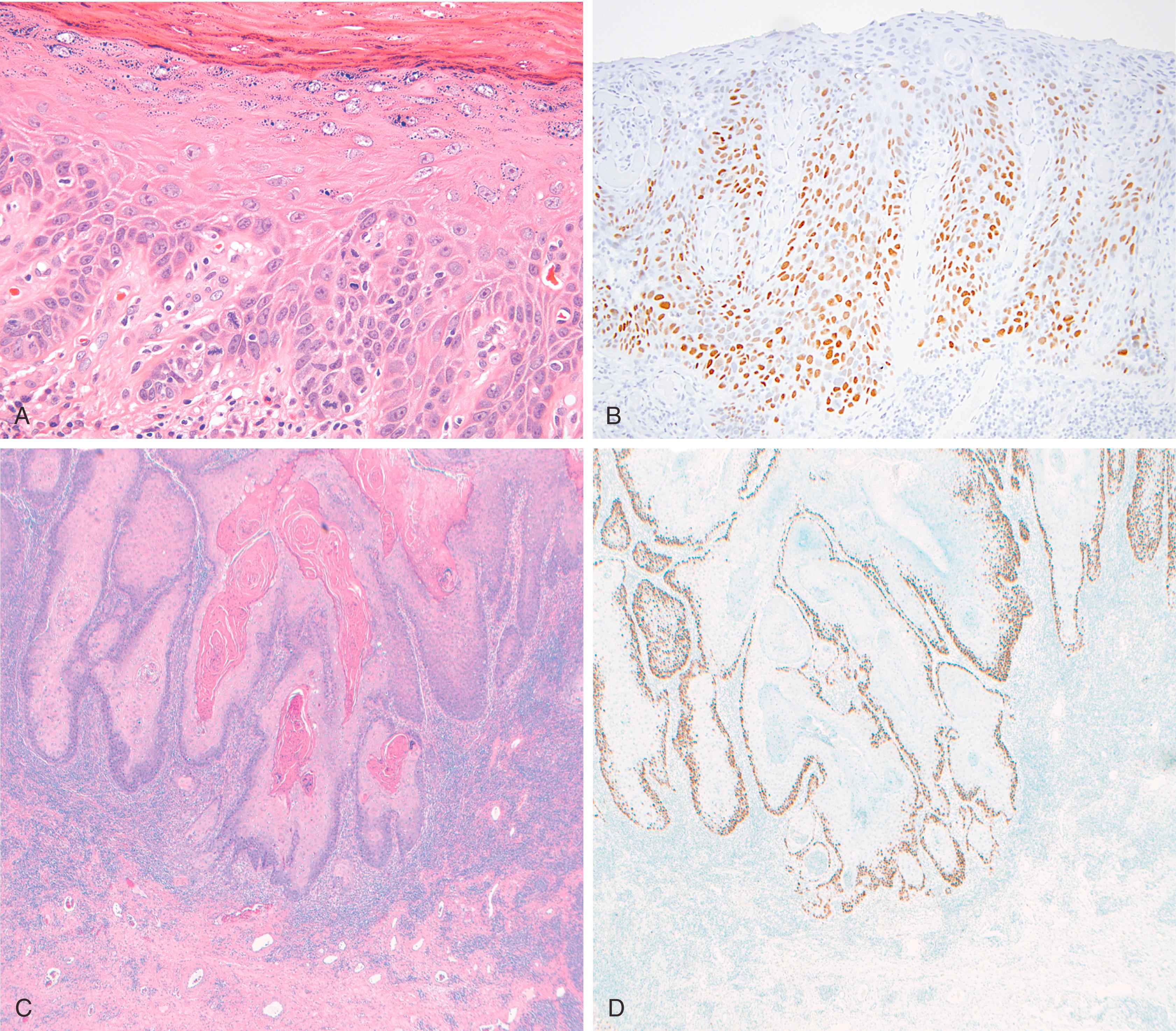 Fig. 18.5, (A) Differentiated vulvar intraepithelial neoplasia consists of nuclear atypia and brisk mitoses confined to the basal zone (hematoxylin and eosin). (B) Tumor cells may express p53 and MIB-1 (not shown) in the basal and parabasal layers but typically do not express p16. Invasive squamous cell carcinomas (hematoxylin and eosin), (C) arising from these lesions may show abnormal over-expression of p53 along the edges of the invasive nests (D).