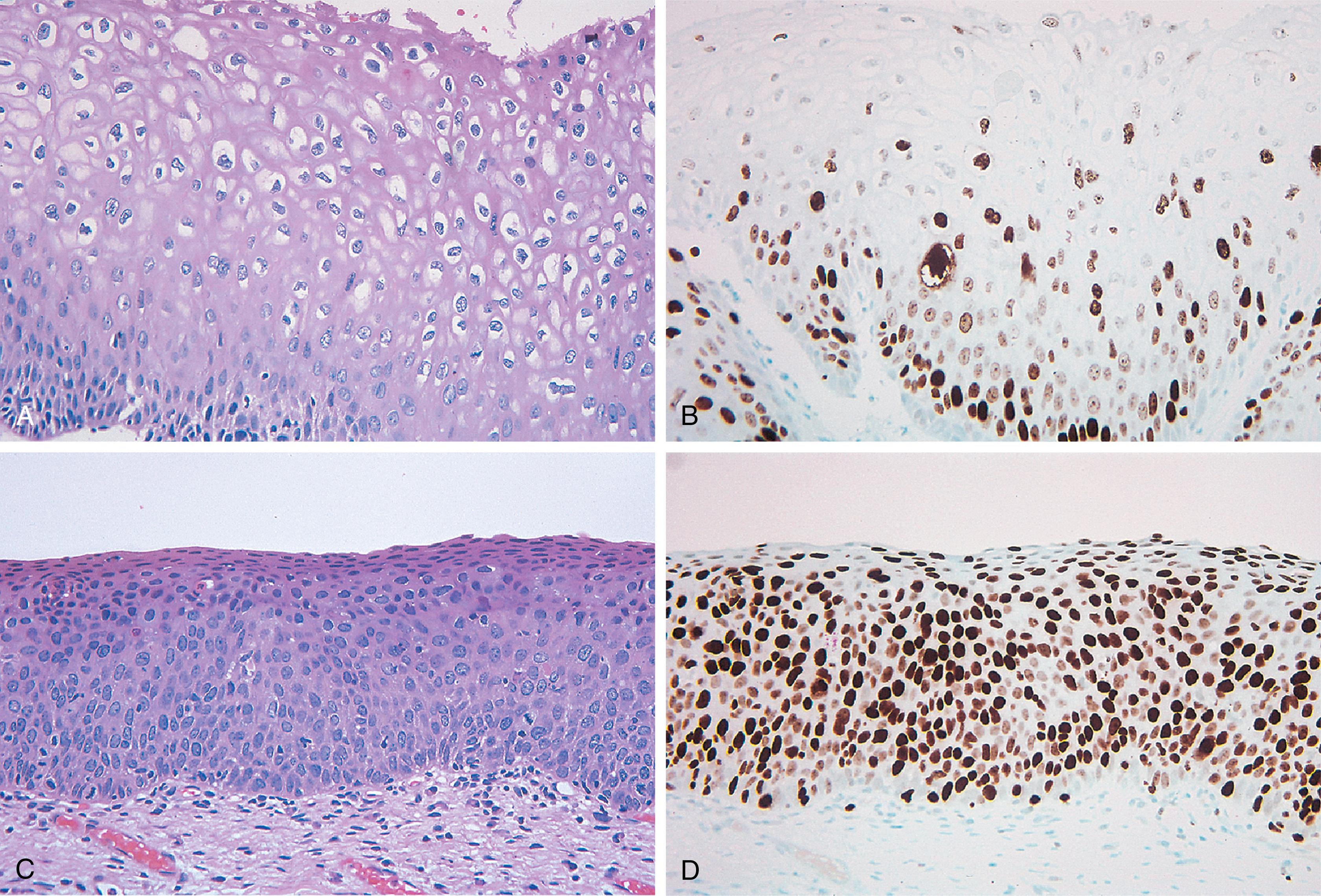 Fig. 18.6, MIB-1 is expressed variably in the middle and upper layers of cervical low-grade squamous intraepithelial lesions (A and B) and diffusely throughout the full thickness of cervical high-grade squamous intraepithelial lesions (C and D). The superficial layer may be spared.