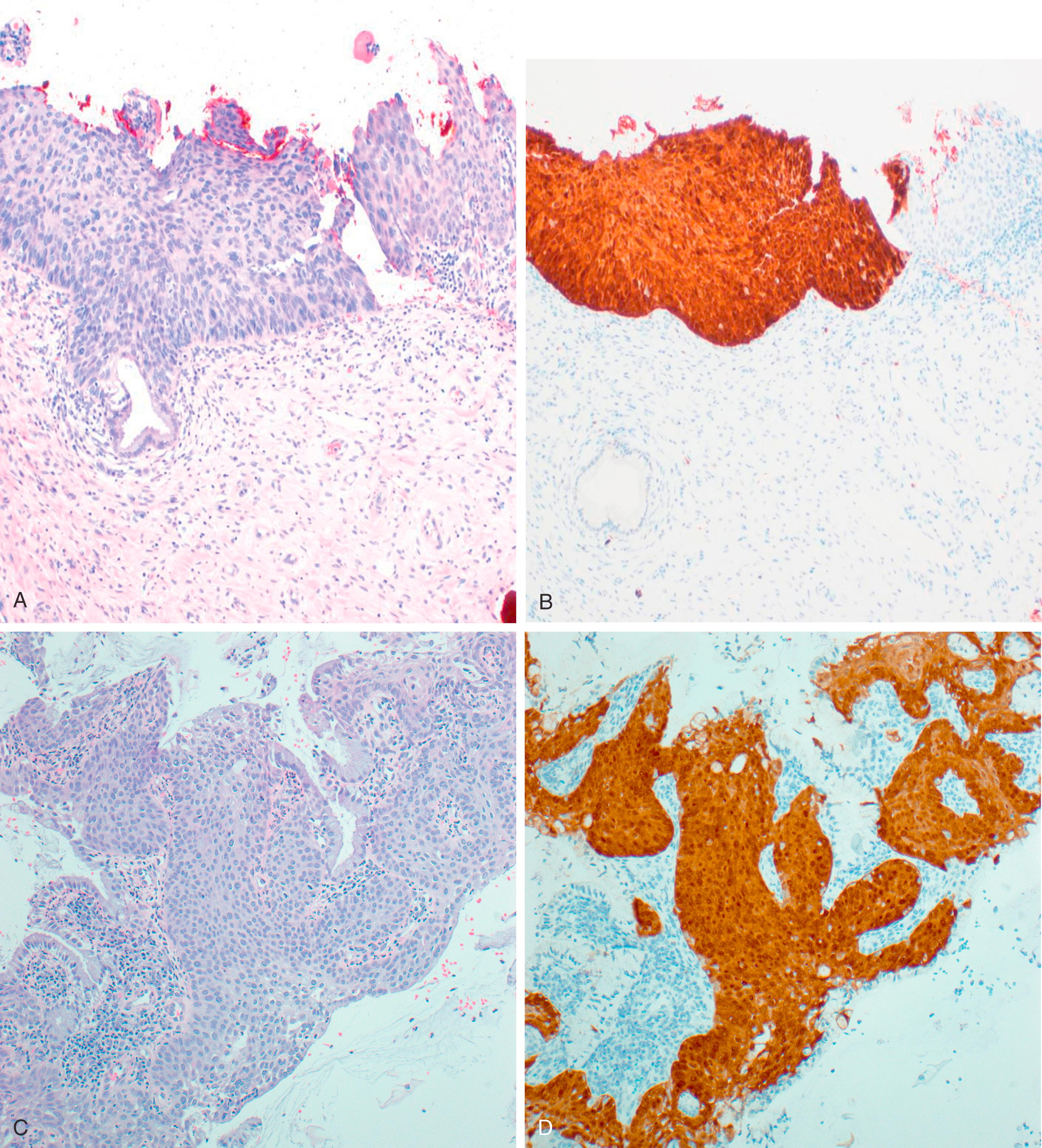 Fig. 18.7, HSIL (CIN 2) (hematoxylin and eosin, A) with diffuse and strong expression of p16 throughout the entire thickness of the lesion (B). HSIL occurring in metaplastic epithelium (hematoxylin and eosin) (C) can be morphologically challenging and is nicely highlighted by strong positive staining for p16 (D). LSIL (hematoxylin and eosin) (E) typically only shows patchy p16 expression (F). However, LSIL (hematoxylin and eosin) (G) can also show strong and diffuse p16 (H) in some cases.