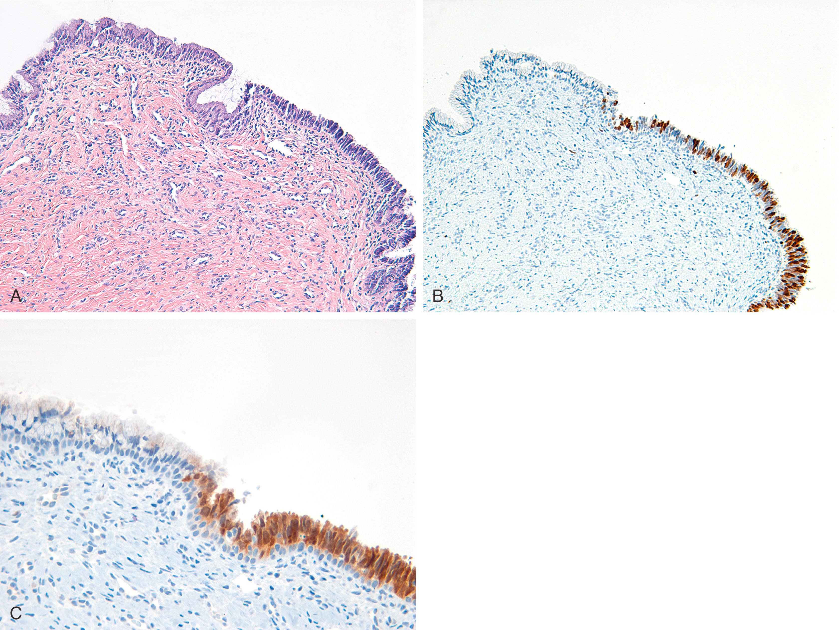 Fig. 18.8, (A) Endocervical adenocarcinoma in situ may mimic reactive, inflamed surface epithelium (hematoxylin and eosin); however, it is distinguished by diffuse molecular immunology Borstel 1 (MIB-1) expression (B) and diffuse p16 expression (C). These markers highlight the typical abrupt transition between normal and neoplastic epithelium.