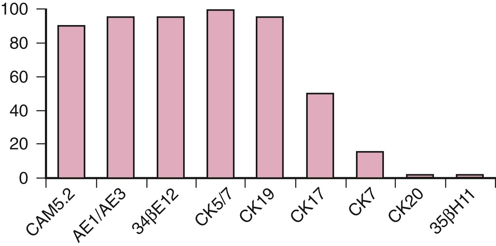 Fig. 14.2, Cytokeratin (CK) reactivity in esophageal squamous cell carcinoma.